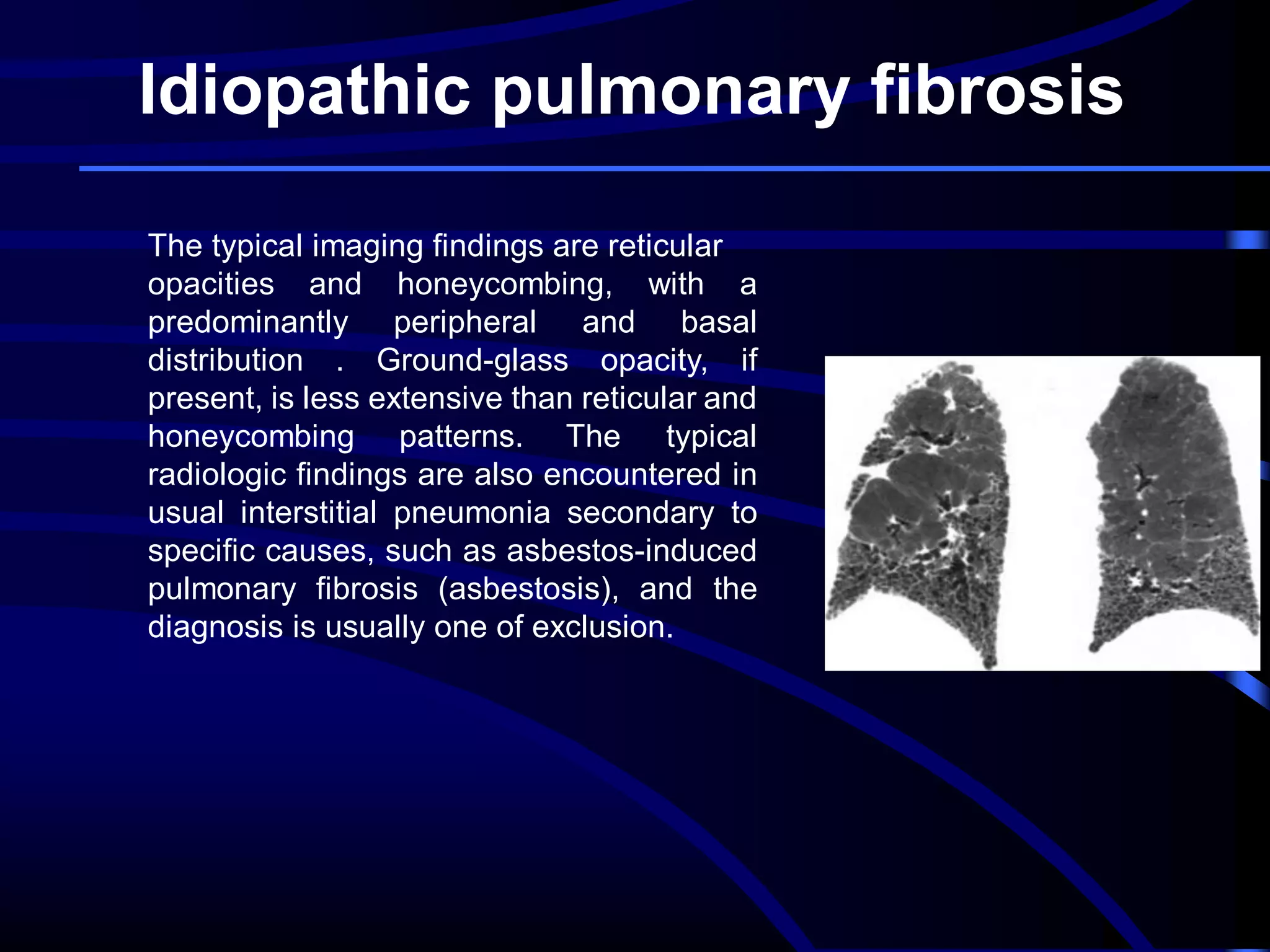 Idiopathic pulmonary fibrosis
The typical imaging findings are reticular
opacities and honeycombing, with a
predominantly peripheral and basal
distribution . Ground-glass opacity, if
present, is less extensive than reticular and
honeycombing patterns. The typical
radiologic findings are also encountered in
usual interstitial pneumonia secondary to
specific causes, such as asbestos-induced
pulmonary fibrosis (asbestosis), and the
diagnosis is usually one of exclusion.

 
