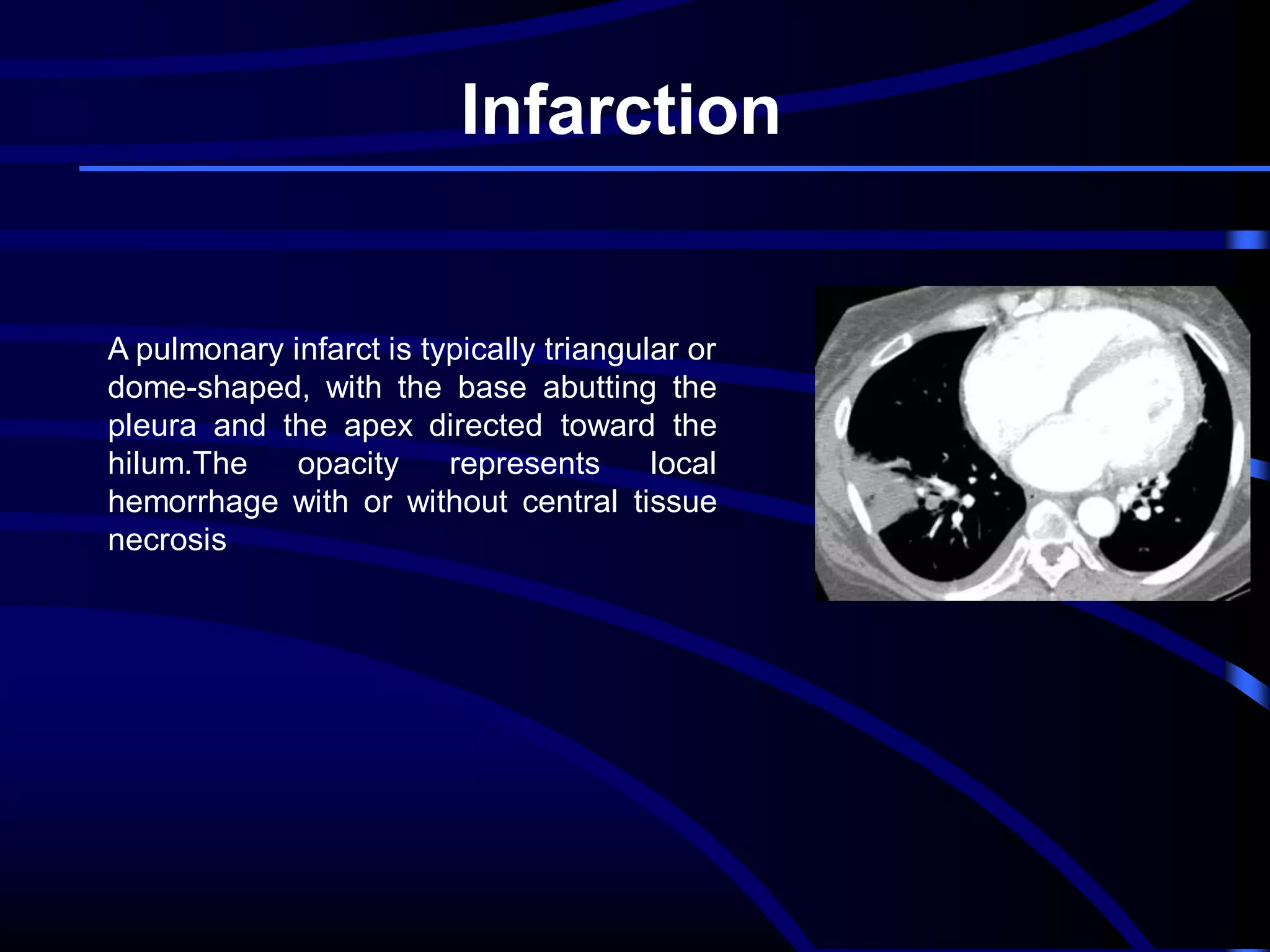 Infarction

A pulmonary infarct is typically triangular or
dome-shaped, with the base abutting the
pleura and the apex directed toward the
hilum.The
opacity
represents
local
hemorrhage with or without central tissue
necrosis

 