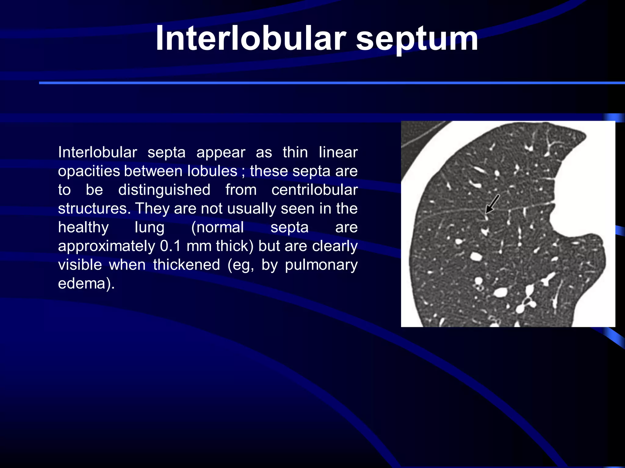 Interlobular septum

Interlobular septa appear as thin linear
opacities between lobules ; these septa are
to be distinguished from centrilobular
structures. They are not usually seen in the
healthy
lung
(normal
septa
are
approximately 0.1 mm thick) but are clearly
visible when thickened (eg, by pulmonary
edema).

 