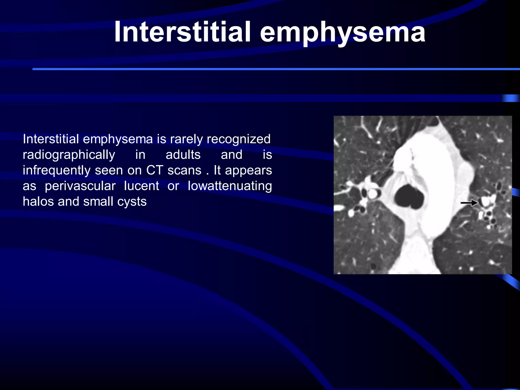Interstitial emphysema

Interstitial emphysema is rarely recognized
radiographically
in
adults
and
is
infrequently seen on CT scans . It appears
as perivascular lucent or lowattenuating
halos and small cysts

 