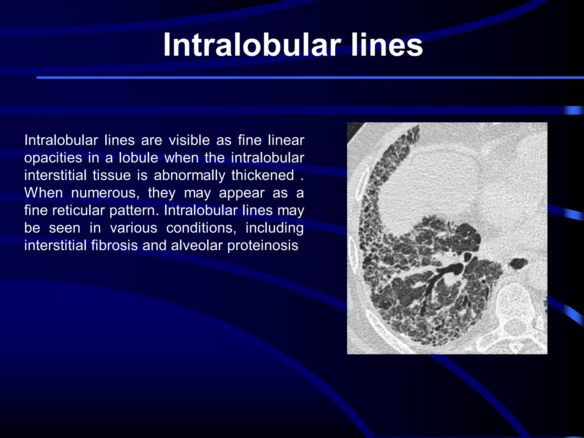 Intralobular lines
Intralobular lines are visible as fine linear
opacities in a lobule when the intralobular
interstitial tissue is abnormally thickened .
When numerous, they may appear as a
fine reticular pattern. Intralobular lines may
be seen in various conditions, including
interstitial fibrosis and alveolar proteinosis

 