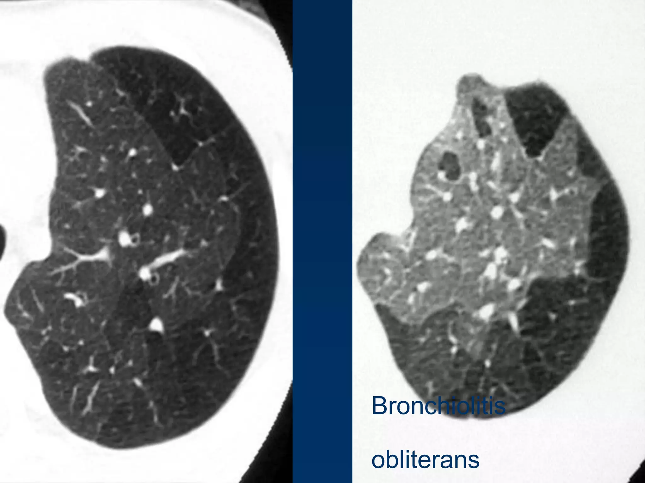 Bronchiolitis

obliterans

 