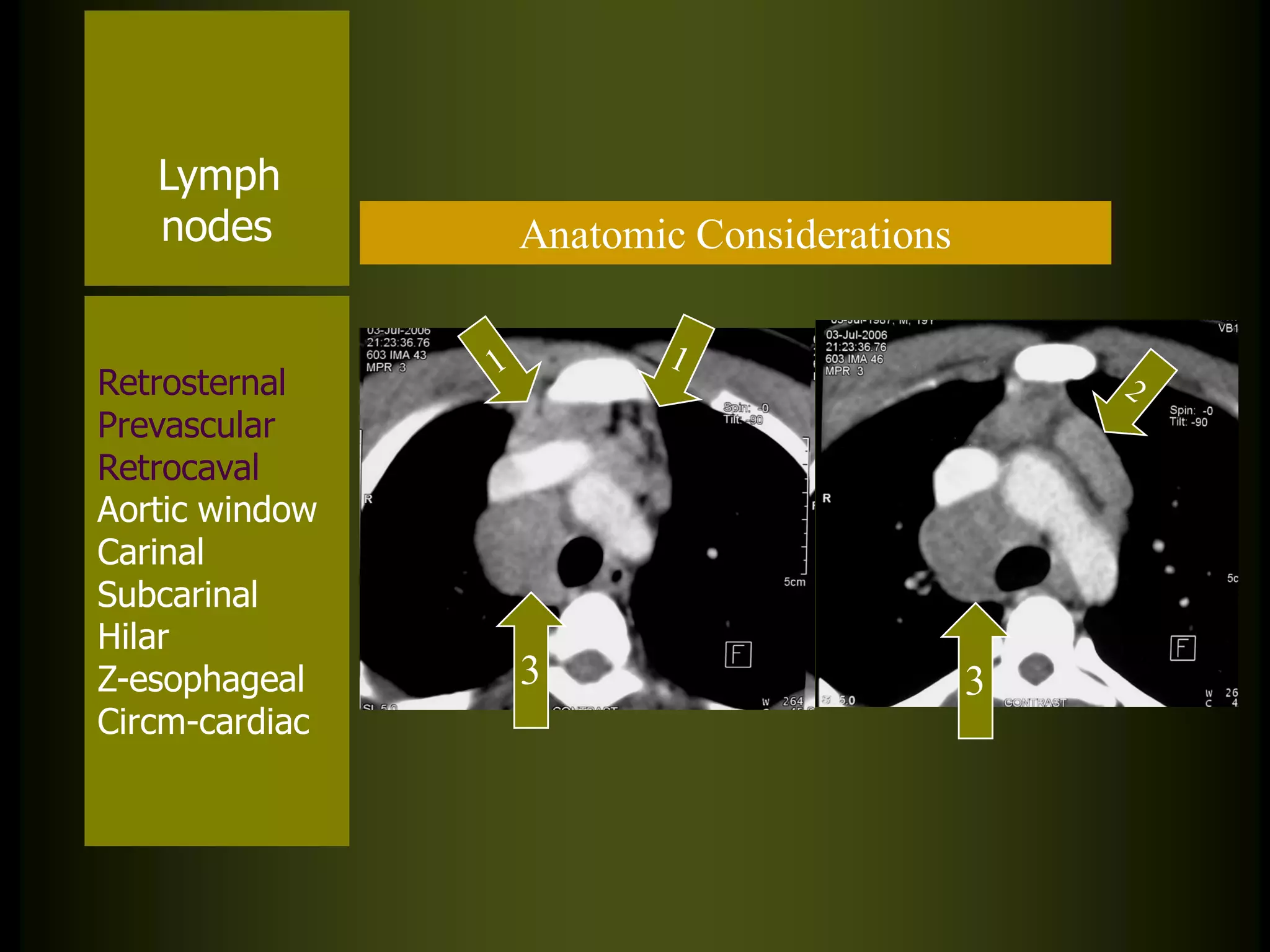 Lymph
nodes

Retrosternal
Prevascular
Retrocaval
Aortic window
Carinal
Subcarinal
Hilar
Z-esophageal
Circm-cardiac

Anatomic Considerations

3

3

 