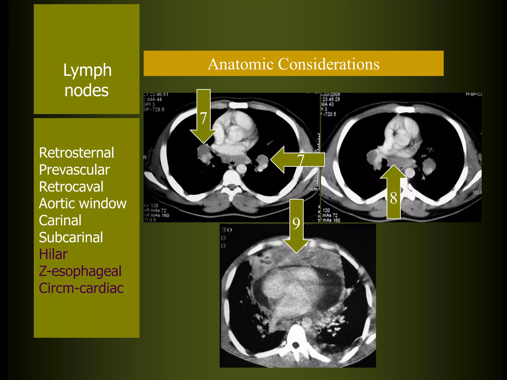 Lymph
nodes

Anatomic Considerations
7

Retrosternal
Prevascular
Retrocaval
Aortic window
Carinal
Subcarinal
Hilar
Z-esophageal
Circm-cardiac

7
8
9

 
