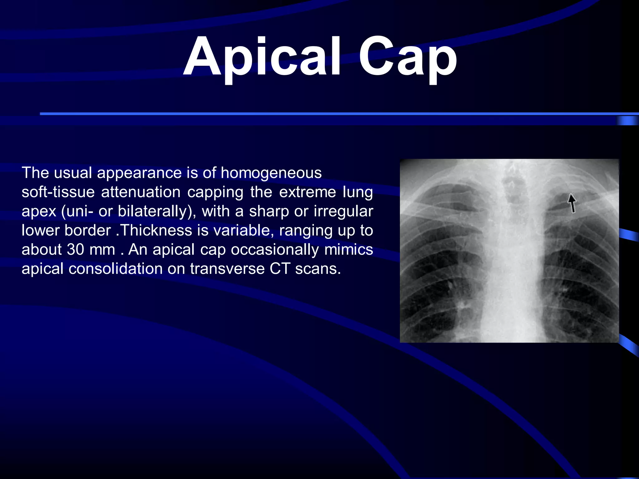 Apical Cap
The usual appearance is of homogeneous
soft-tissue attenuation capping the extreme lung
apex (uni- or bilaterally), with a sharp or irregular
lower border .Thickness is variable, ranging up to
about 30 mm . An apical cap occasionally mimics
apical consolidation on transverse CT scans.

 