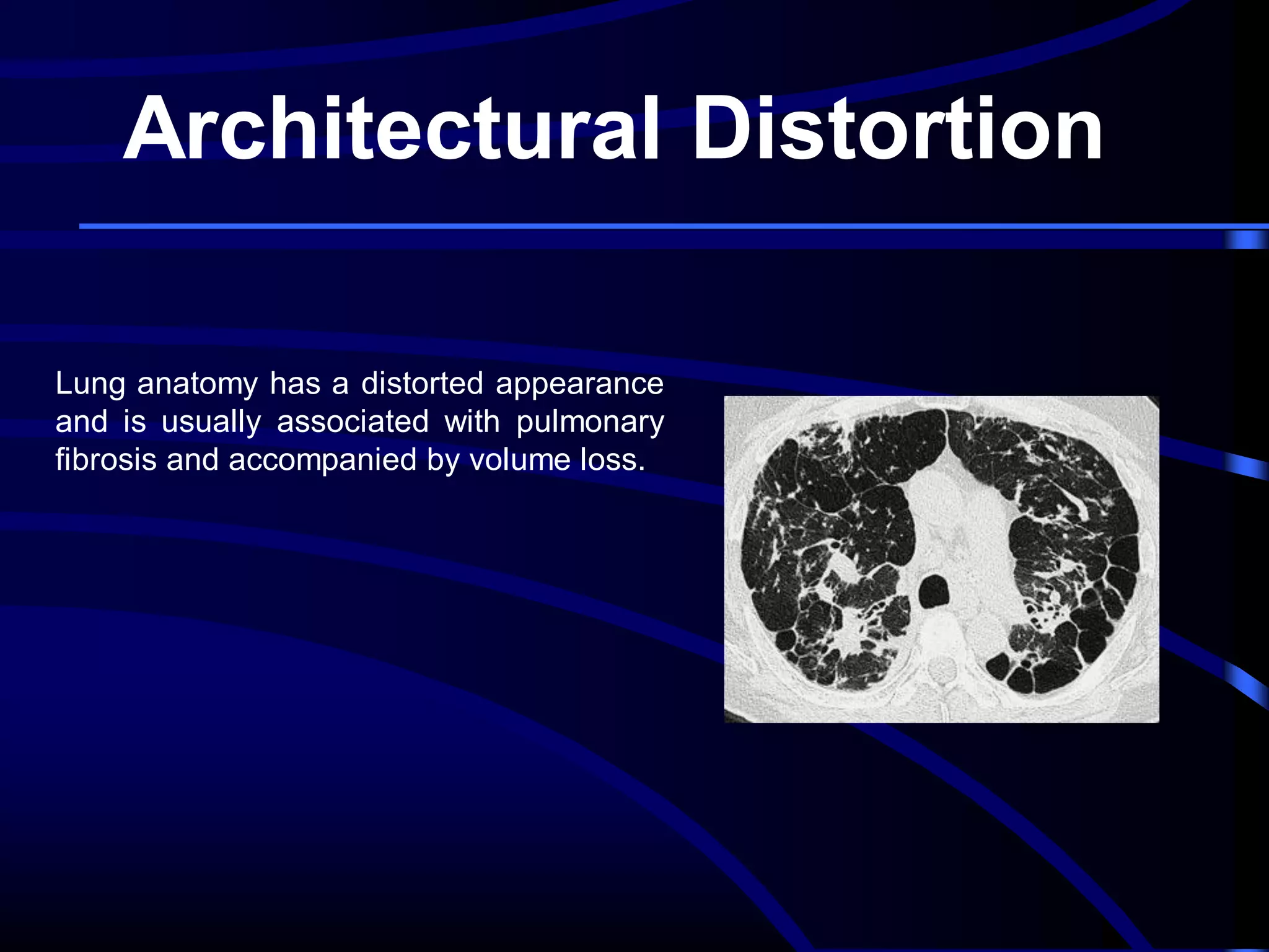 Architectural Distortion
Lung anatomy has a distorted appearance
and is usually associated with pulmonary
fibrosis and accompanied by volume loss.

 