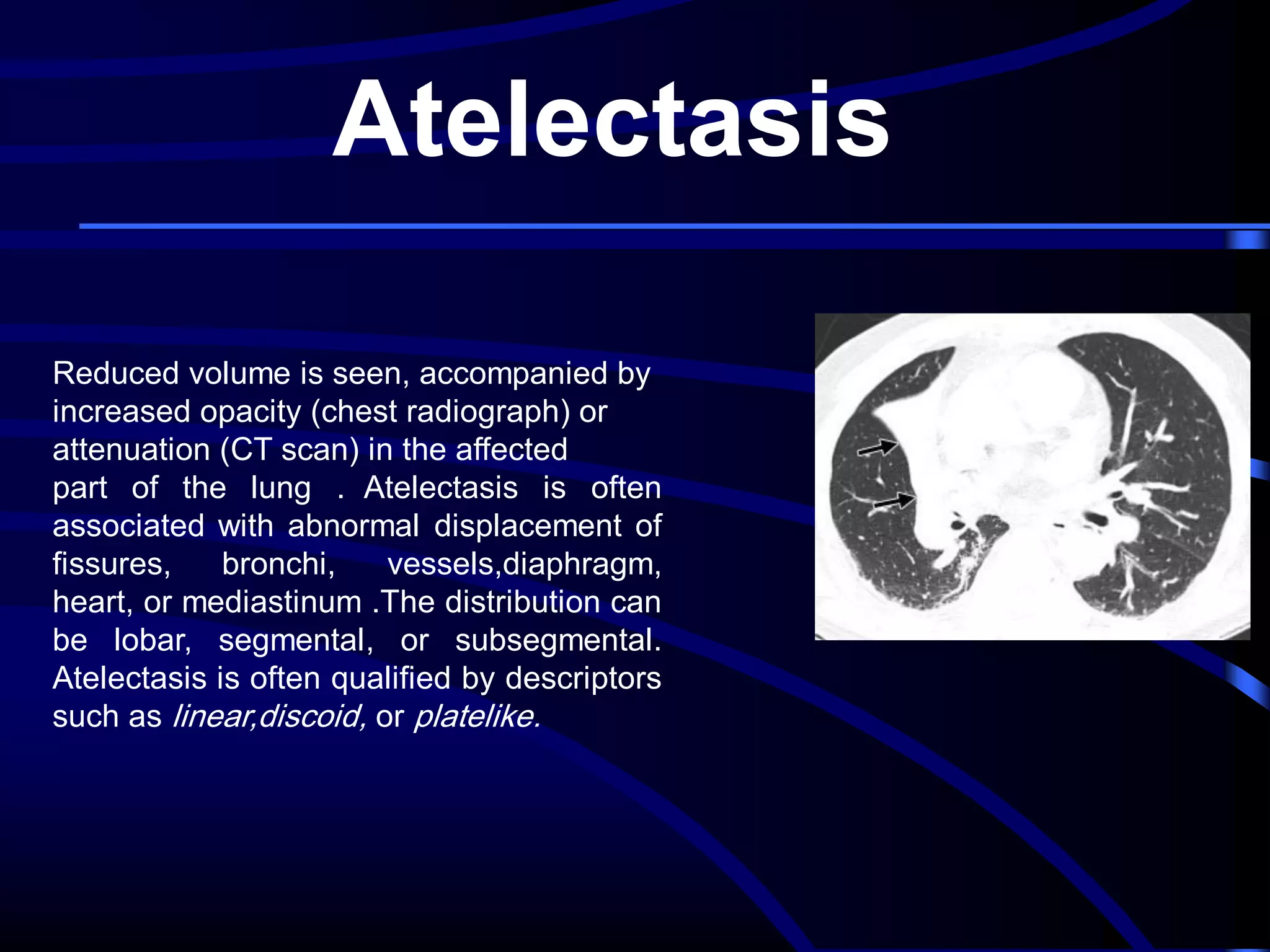 Atelectasis
Reduced volume is seen, accompanied by
increased opacity (chest radiograph) or
attenuation (CT scan) in the affected
part of the lung . Atelectasis is often
associated with abnormal displacement of
fissures,
bronchi,
vessels,diaphragm,
heart, or mediastinum .The distribution can
be lobar, segmental, or subsegmental.
Atelectasis is often qualified by descriptors
such as linear,discoid, or platelike.

 
