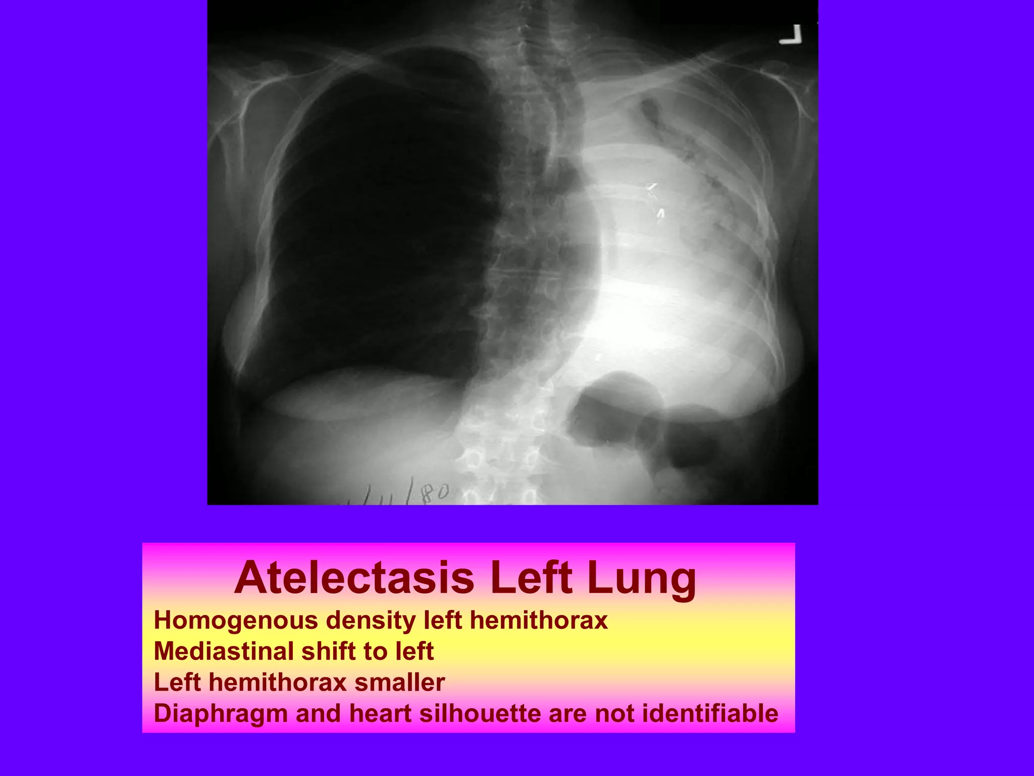 Atelectasis Left Lung
Homogenous density left hemithorax
Mediastinal shift to left
Left hemithorax smaller
Diaphragm and heart silhouette are not identifiable

 