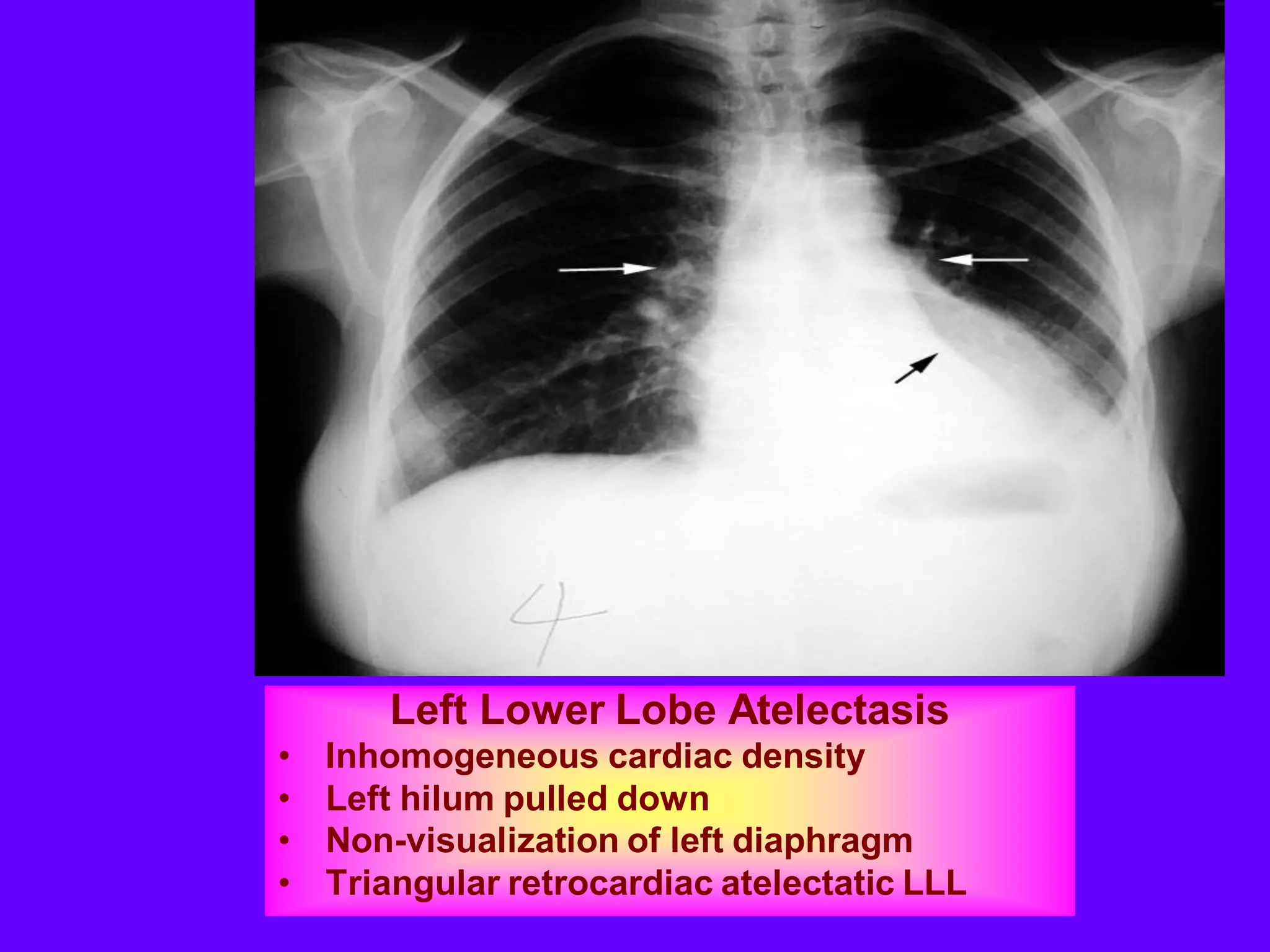 Left Lower Lobe Atelectasis
•
•
•
•

Inhomogeneous cardiac density
Left hilum pulled down
Non-visualization of left diaphragm
Triangular retrocardiac atelectatic LLL

 