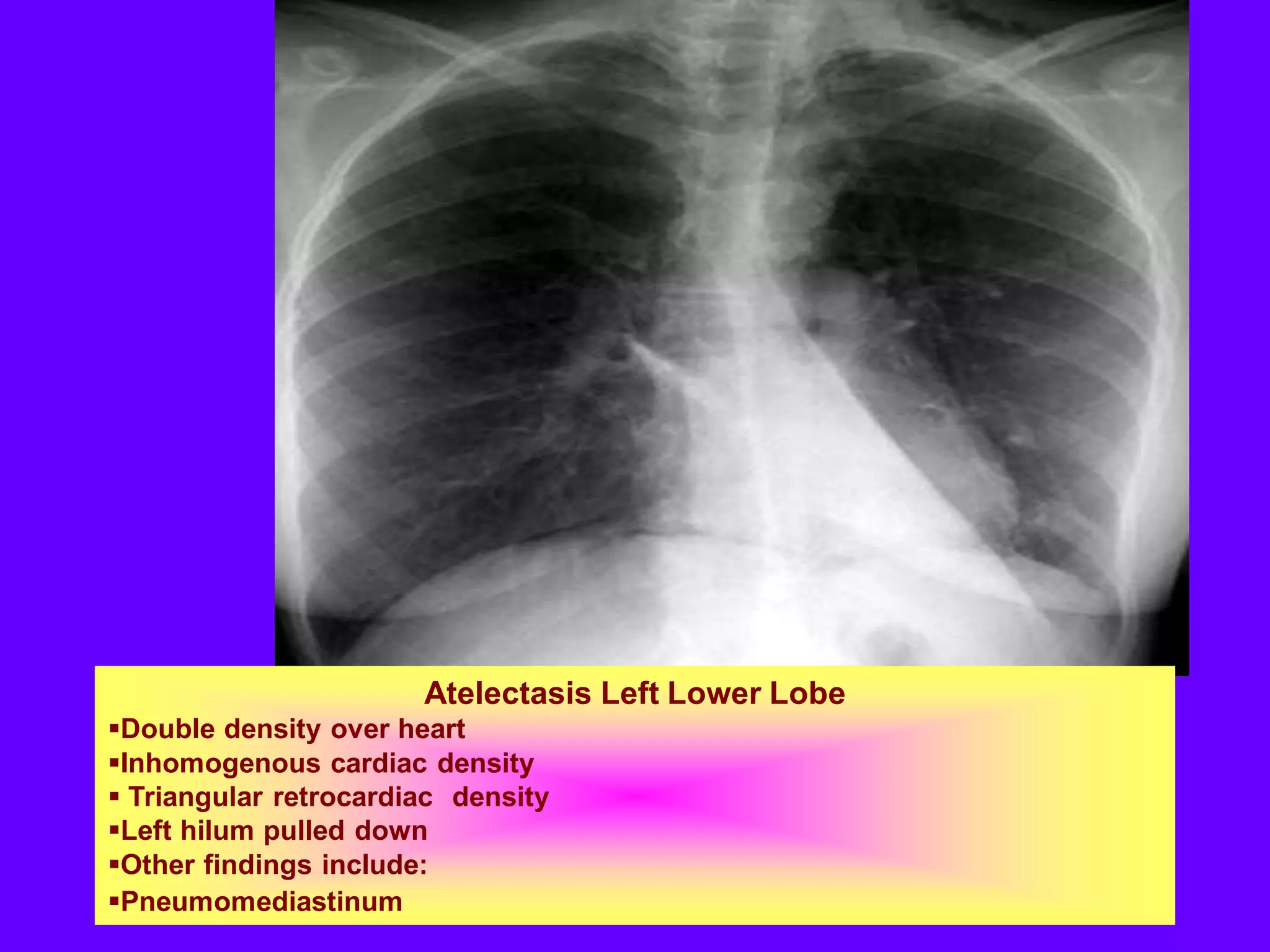 Atelectasis Left Lower Lobe
Double density over heart
Inhomogenous cardiac density
 Triangular retrocardiac density
Left hilum pulled down
Other findings include:
Pneumomediastinum

 