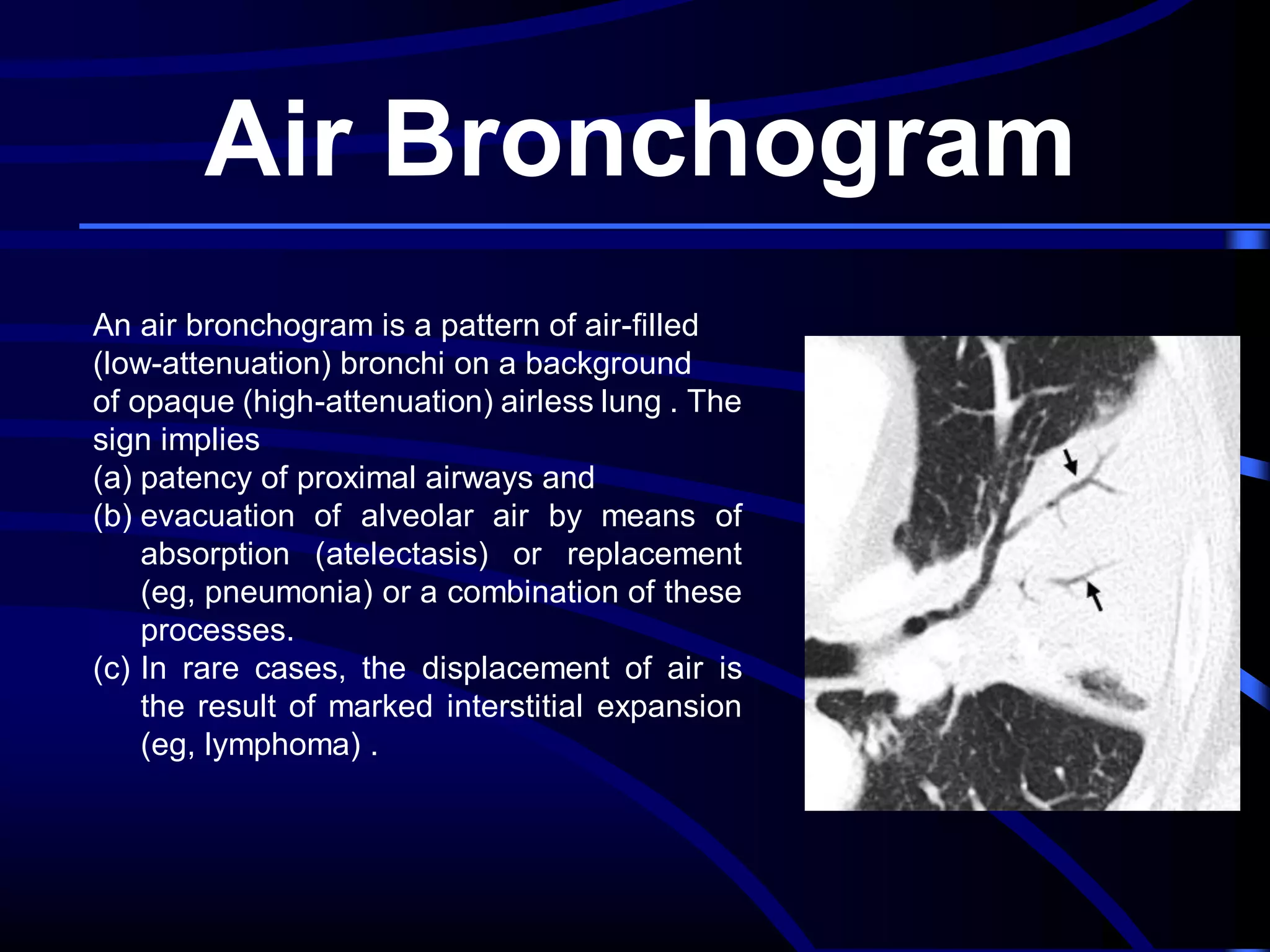 Air Bronchogram
An air bronchogram is a pattern of air-filled
(low-attenuation) bronchi on a background
of opaque (high-attenuation) airless lung . The
sign implies
(a) patency of proximal airways and
(b) evacuation of alveolar air by means of
absorption (atelectasis) or replacement
(eg, pneumonia) or a combination of these
processes.
(c) In rare cases, the displacement of air is
the result of marked interstitial expansion
(eg, lymphoma) .

 