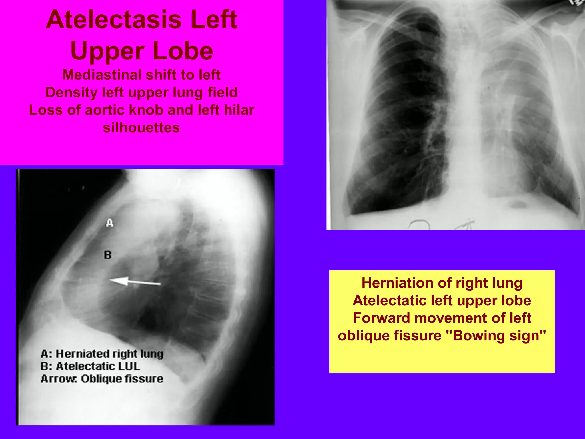 Atelectasis Left
Upper Lobe
Mediastinal shift to left
Density left upper lung field
Loss of aortic knob and left hilar
silhouettes

Herniation of right lung
Atelectatic left upper lobe
Forward movement of left
oblique fissure "Bowing sign"

 