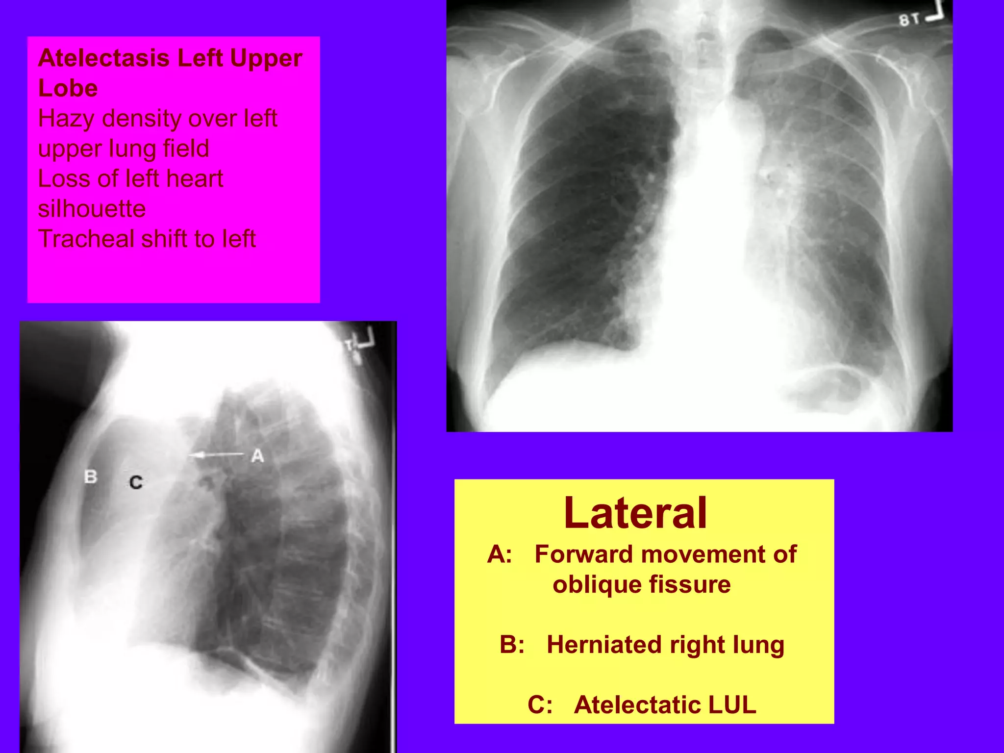 Atelectasis Left Upper
Lobe
Hazy density over left
upper lung field
Loss of left heart
silhouette
Tracheal shift to left

Lateral
A: Forward movement of
oblique fissure

B: Herniated right lung
C: Atelectatic LUL

 