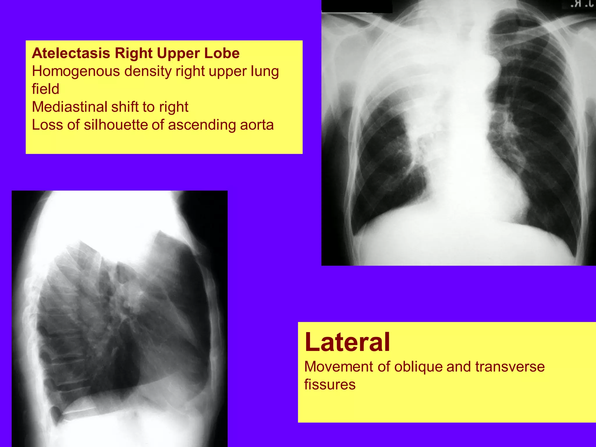 Atelectasis Right Upper Lobe
Homogenous density right upper lung
field
Mediastinal shift to right
Loss of silhouette of ascending aorta

Lateral
Movement of oblique and transverse
fissures

 