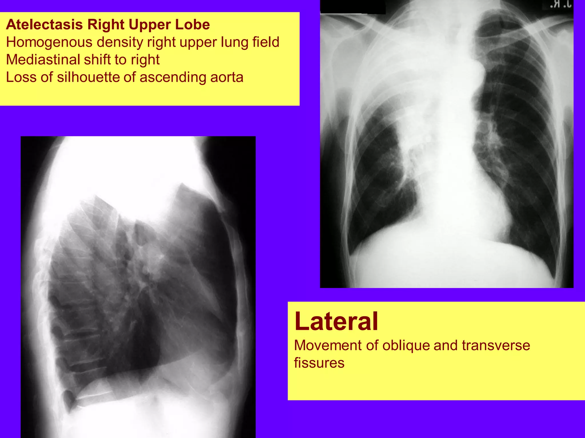 Atelectasis Right Upper Lobe
Homogenous density right upper lung field
Mediastinal shift to right
Loss of silhouette of ascending aorta

Lateral
Movement of oblique and transverse
fissures

 