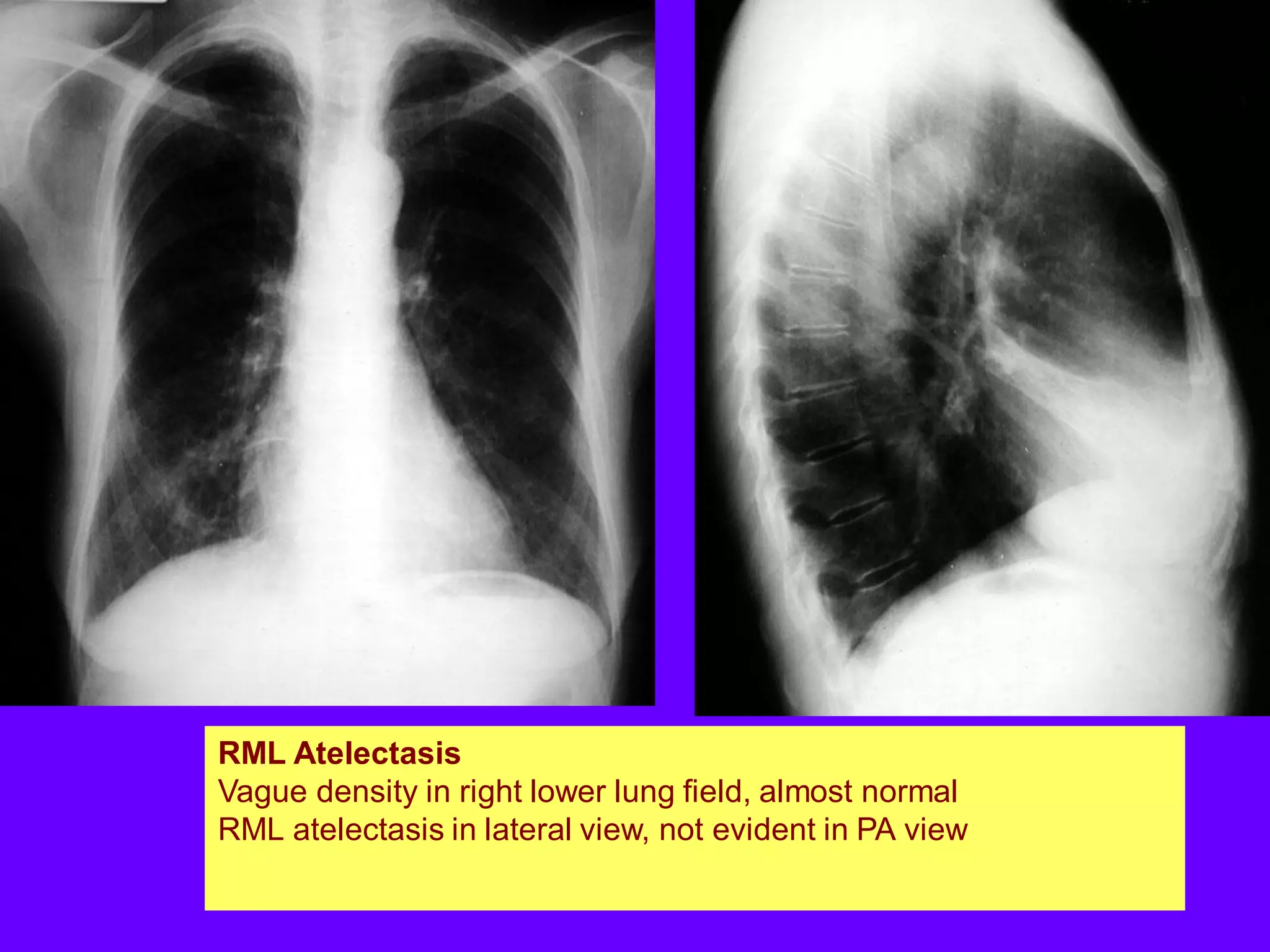 RML Atelectasis
Vague density in right lower lung field, almost normal
RML atelectasis in lateral view, not evident in PA view

 