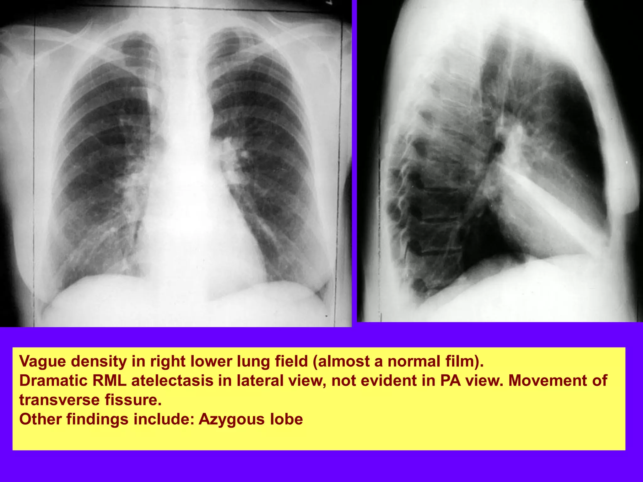 Vague density in right lower lung field (almost a normal film).
Dramatic RML atelectasis in lateral view, not evident in PA view. Movement of
transverse fissure.
Other findings include: Azygous lobe

 