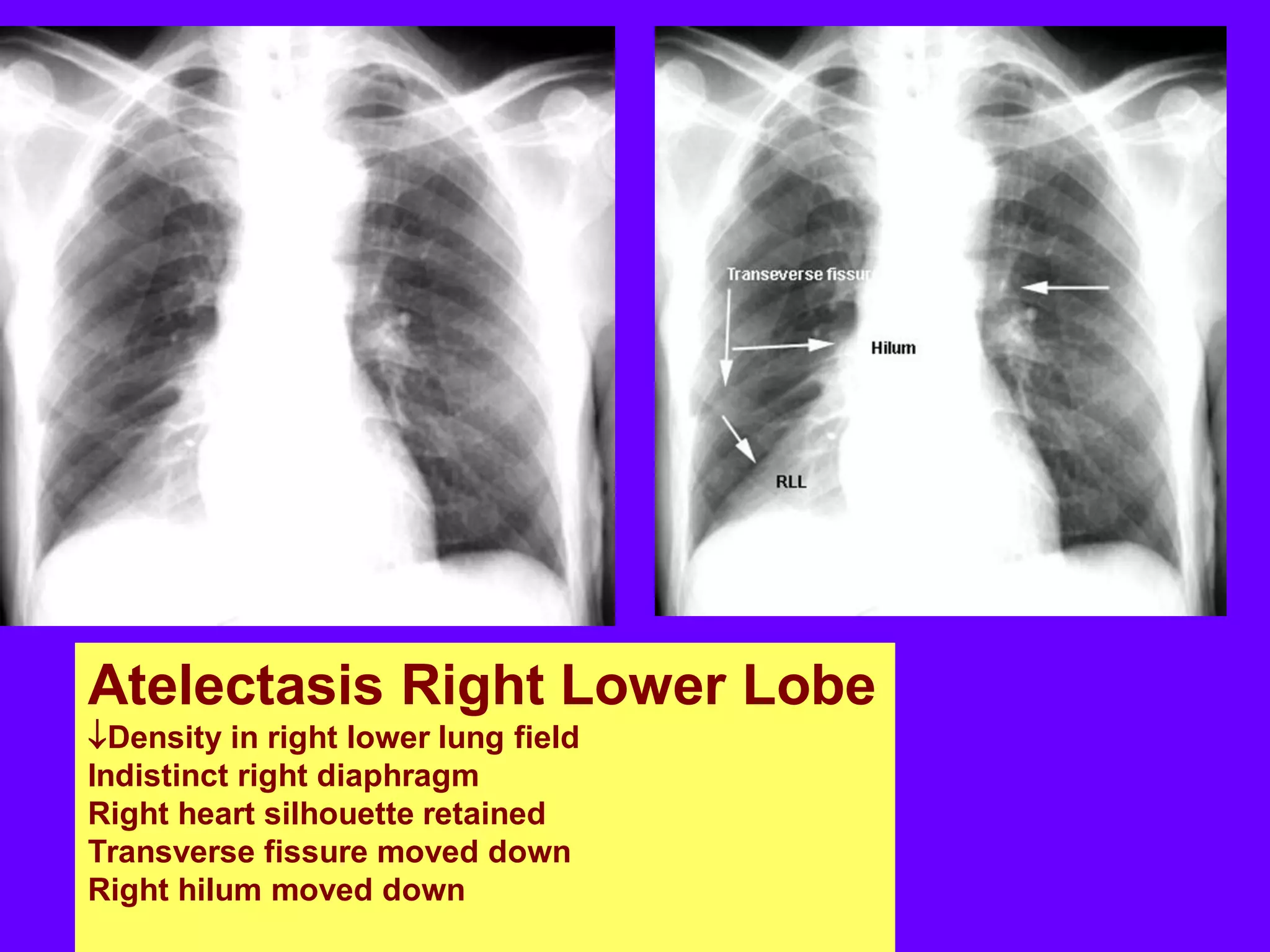 Atelectasis Right Lower Lobe
Density in right lower lung field
Indistinct right diaphragm
Right heart silhouette retained
Transverse fissure moved down
Right hilum moved down

 