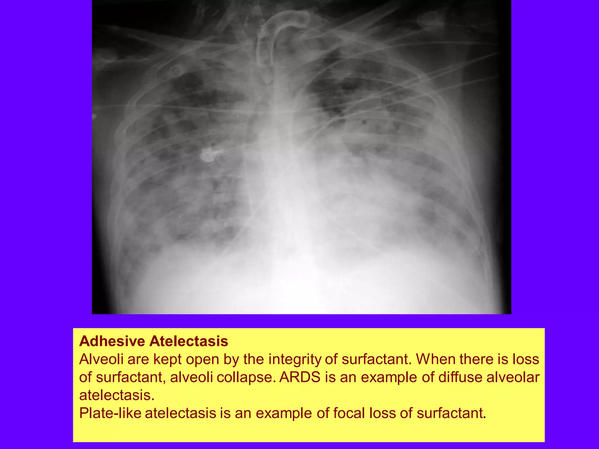 Adhesive Atelectasis
Alveoli are kept open by the integrity of surfactant. When there is loss
of surfactant, alveoli collapse. ARDS is an example of diffuse alveolar
atelectasis.
Plate-like atelectasis is an example of focal loss of surfactant.

 