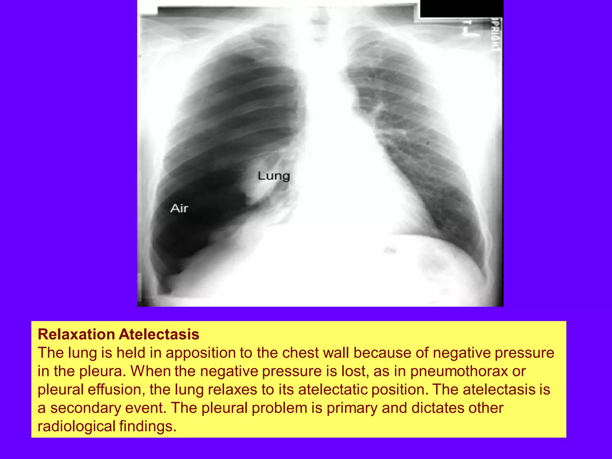 Relaxation Atelectasis
The lung is held in apposition to the chest wall because of negative pressure
in the pleura. When the negative pressure is lost, as in pneumothorax or
pleural effusion, the lung relaxes to its atelectatic position. The atelectasis is
a secondary event. The pleural problem is primary and dictates other
radiological findings.

 