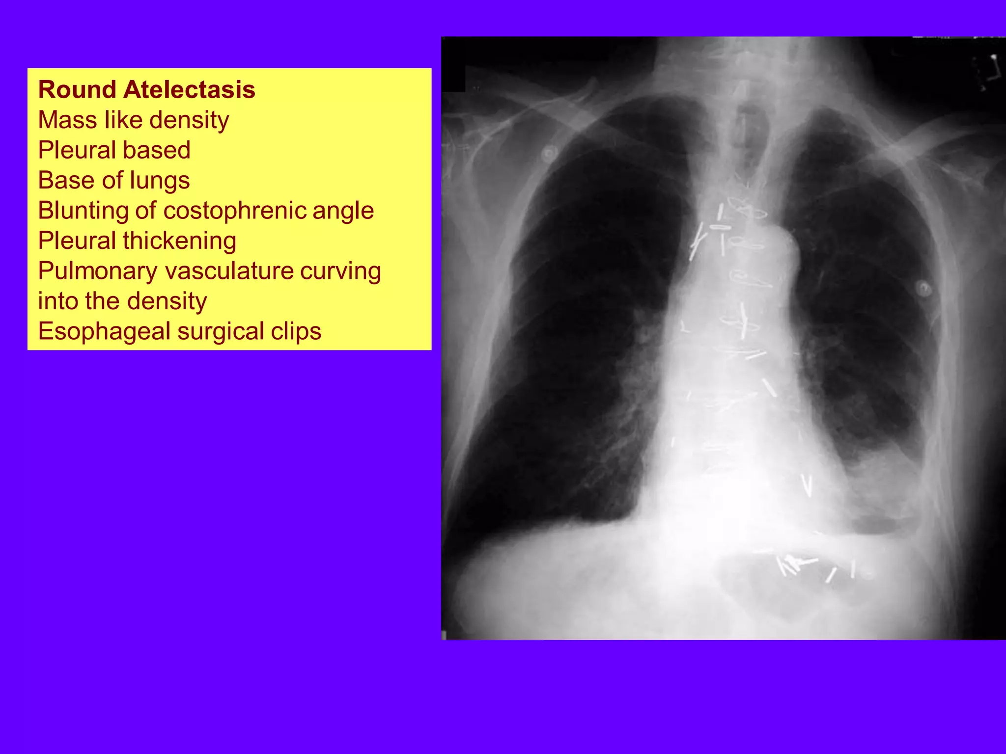 Round Atelectasis
Mass like density
Pleural based
Base of lungs
Blunting of costophrenic angle
Pleural thickening
Pulmonary vasculature curving
into the density
Esophageal surgical clips

 