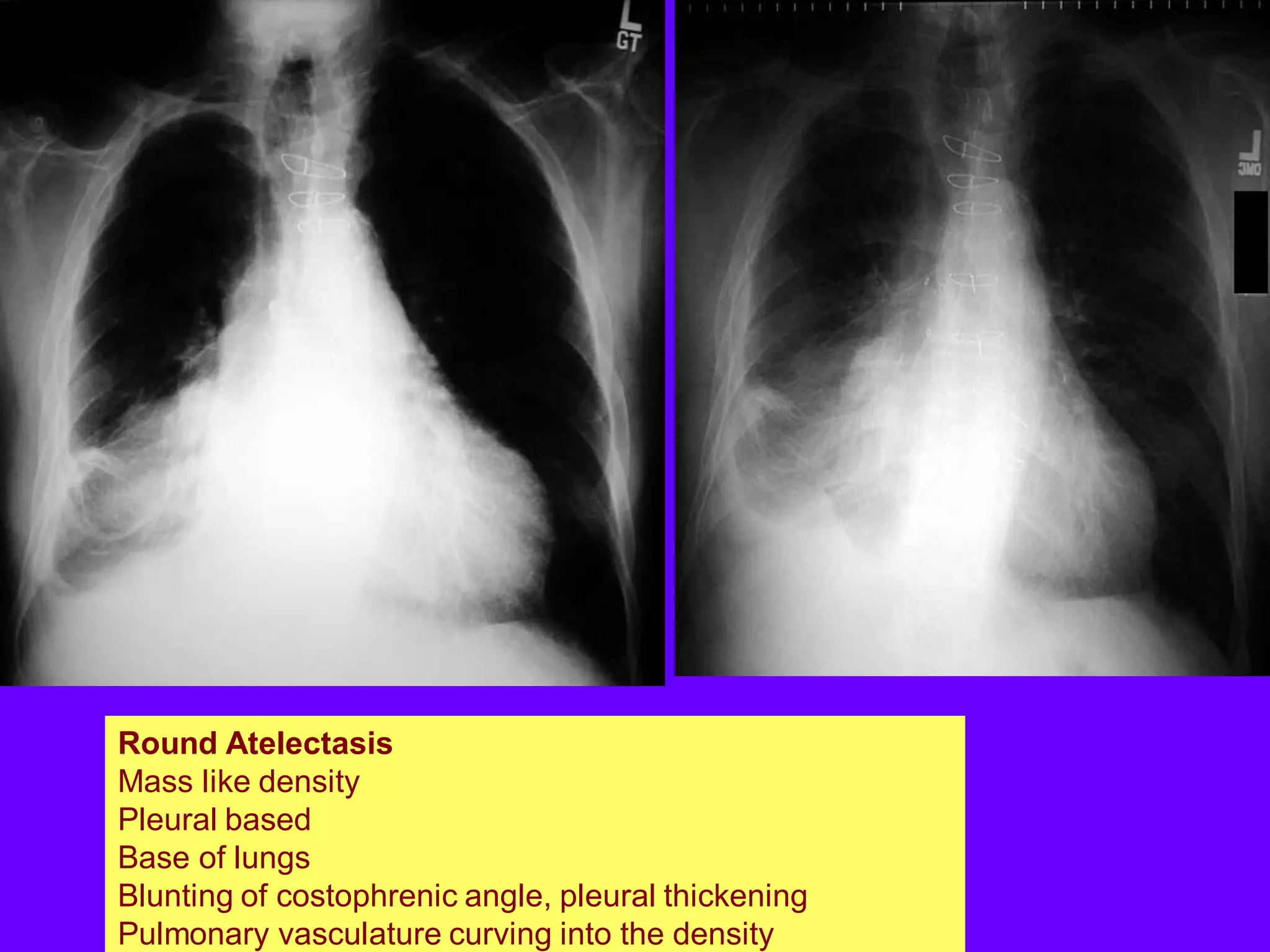 Round Atelectasis
Mass like density
Pleural based
Base of lungs
Blunting of costophrenic angle, pleural thickening
Pulmonary vasculature curving into the density

 