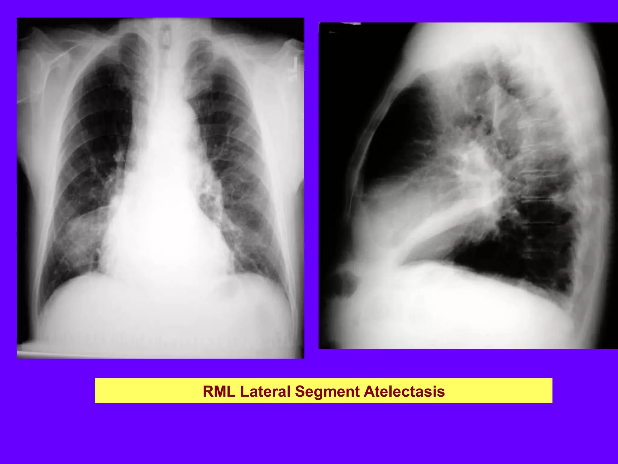 RML Lateral Segment Atelectasis

 