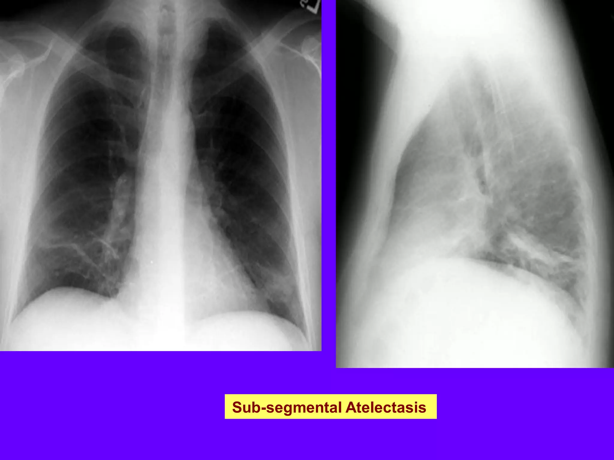 Sub-segmental Atelectasis

 