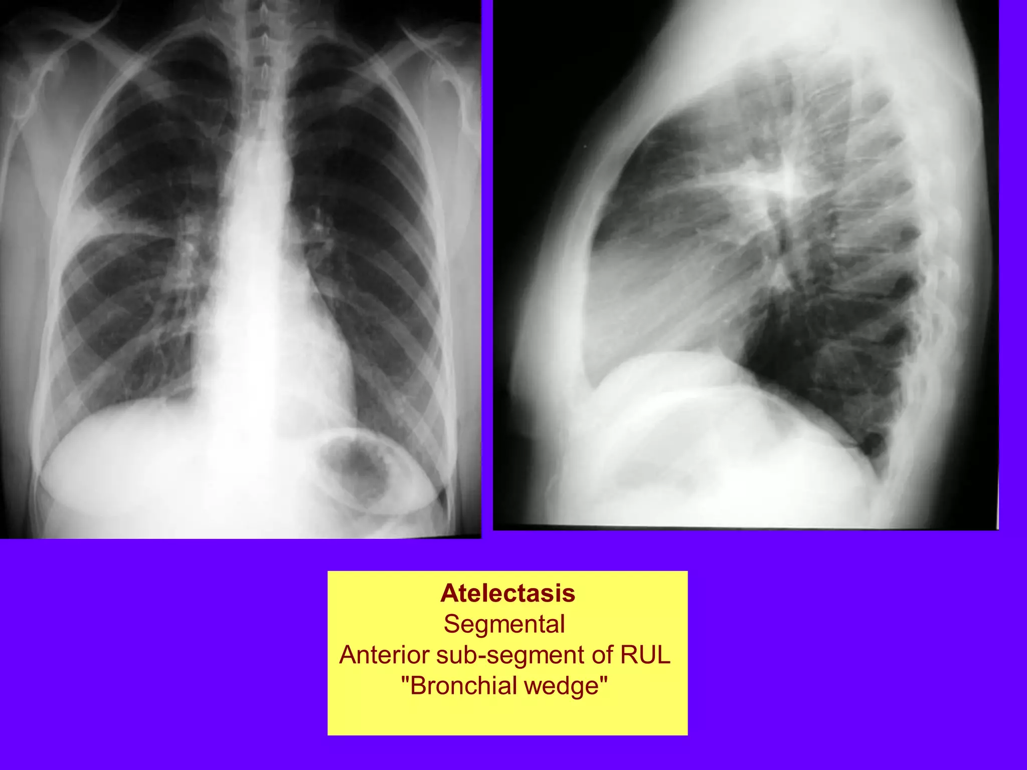Atelectasis
Segmental
Anterior sub-segment of RUL
"Bronchial wedge"

 