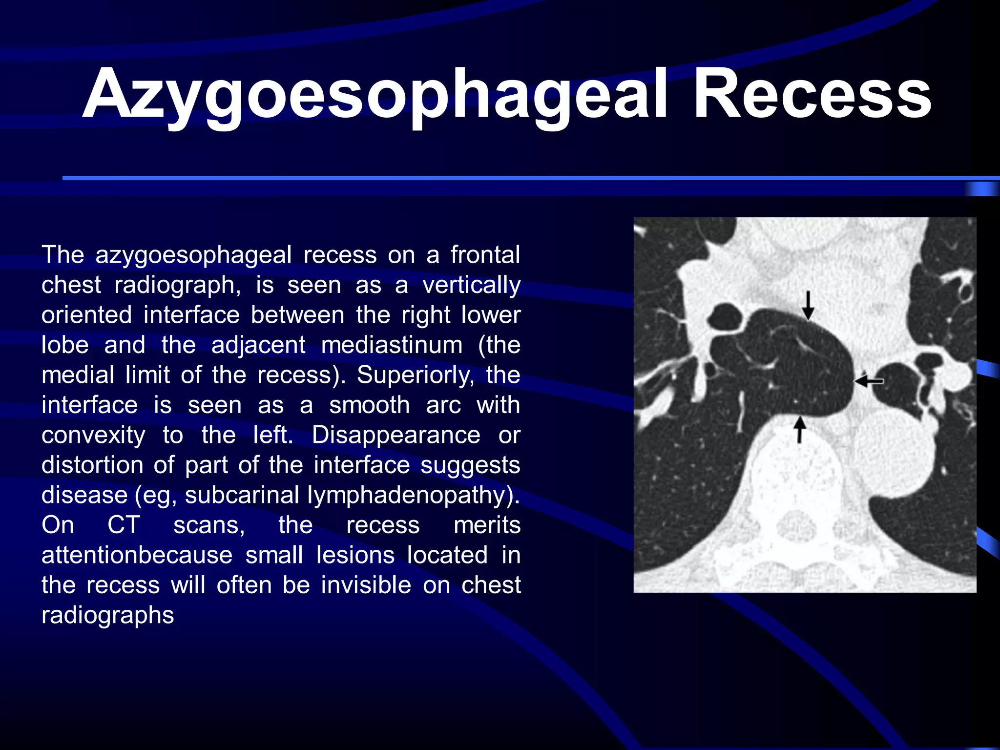 Azygoesophageal Recess
The azygoesophageal recess on a frontal
chest radiograph, is seen as a vertically
oriented interface between the right lower
lobe and the adjacent mediastinum (the
medial limit of the recess). Superiorly, the
interface is seen as a smooth arc with
convexity to the left. Disappearance or
distortion of part of the interface suggests
disease (eg, subcarinal lymphadenopathy).
On CT scans, the recess merits
attentionbecause small lesions located in
the recess will often be invisible on chest
radiographs

 