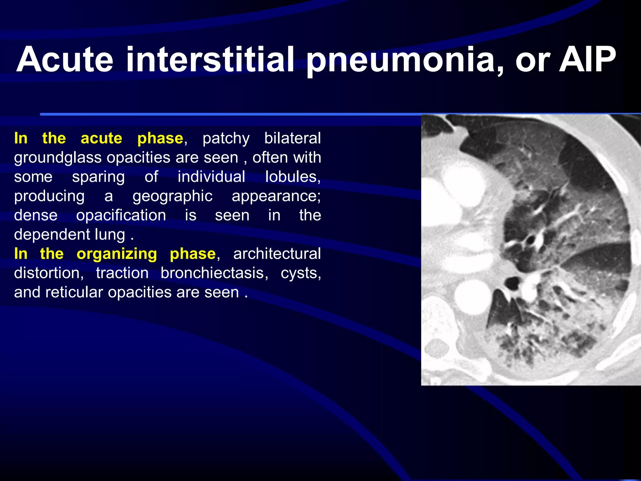 Acute interstitial pneumonia, or AIP
In the acute phase, patchy bilateral
groundglass opacities are seen , often with
some sparing of individual lobules,
producing a geographic appearance;
dense opacification is seen in the
dependent lung .
In the organizing phase, architectural
distortion, traction bronchiectasis, cysts,
and reticular opacities are seen .

 