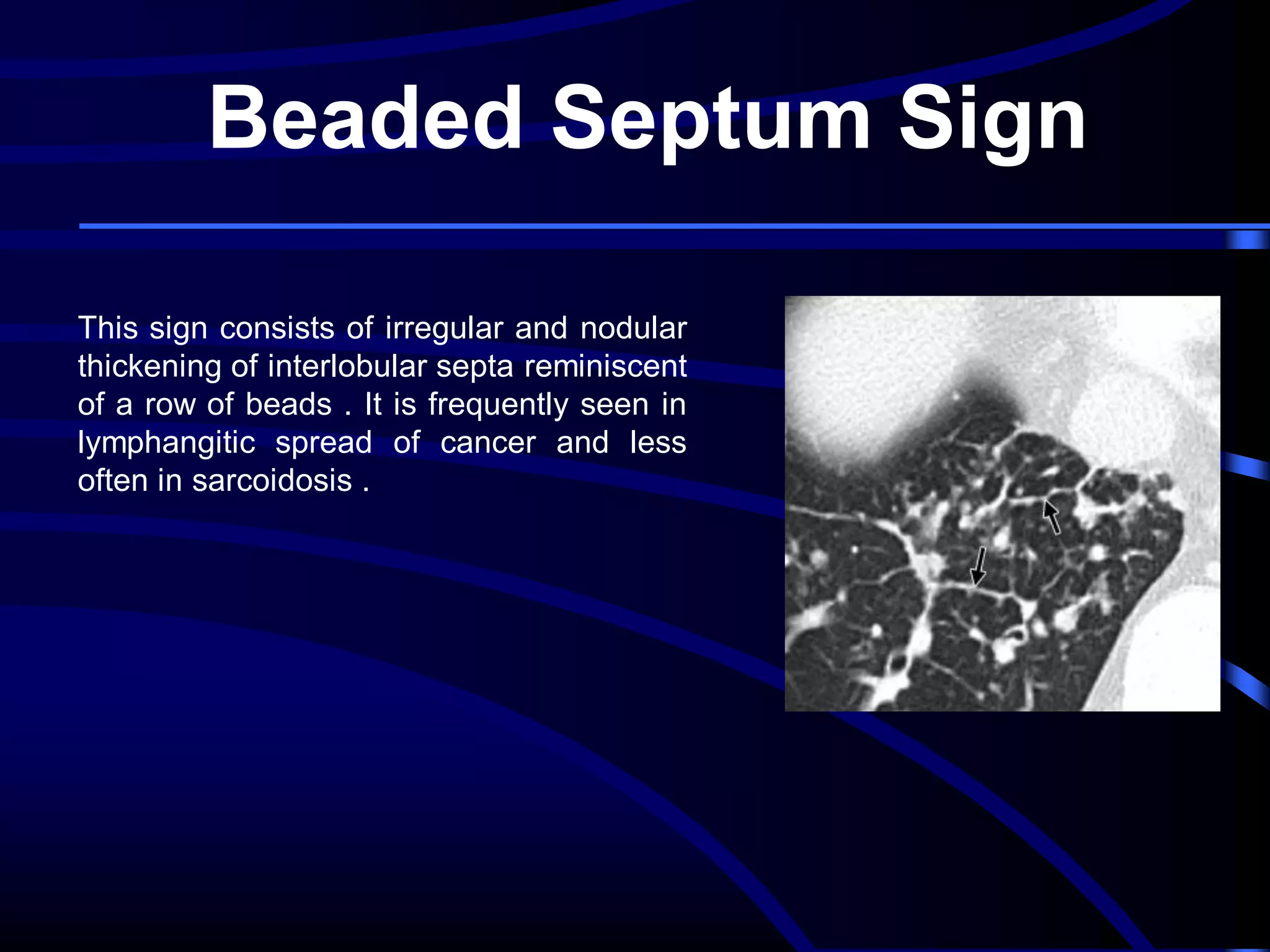 Beaded Septum Sign
This sign consists of irregular and nodular
thickening of interlobular septa reminiscent
of a row of beads . It is frequently seen in
lymphangitic spread of cancer and less
often in sarcoidosis .

 