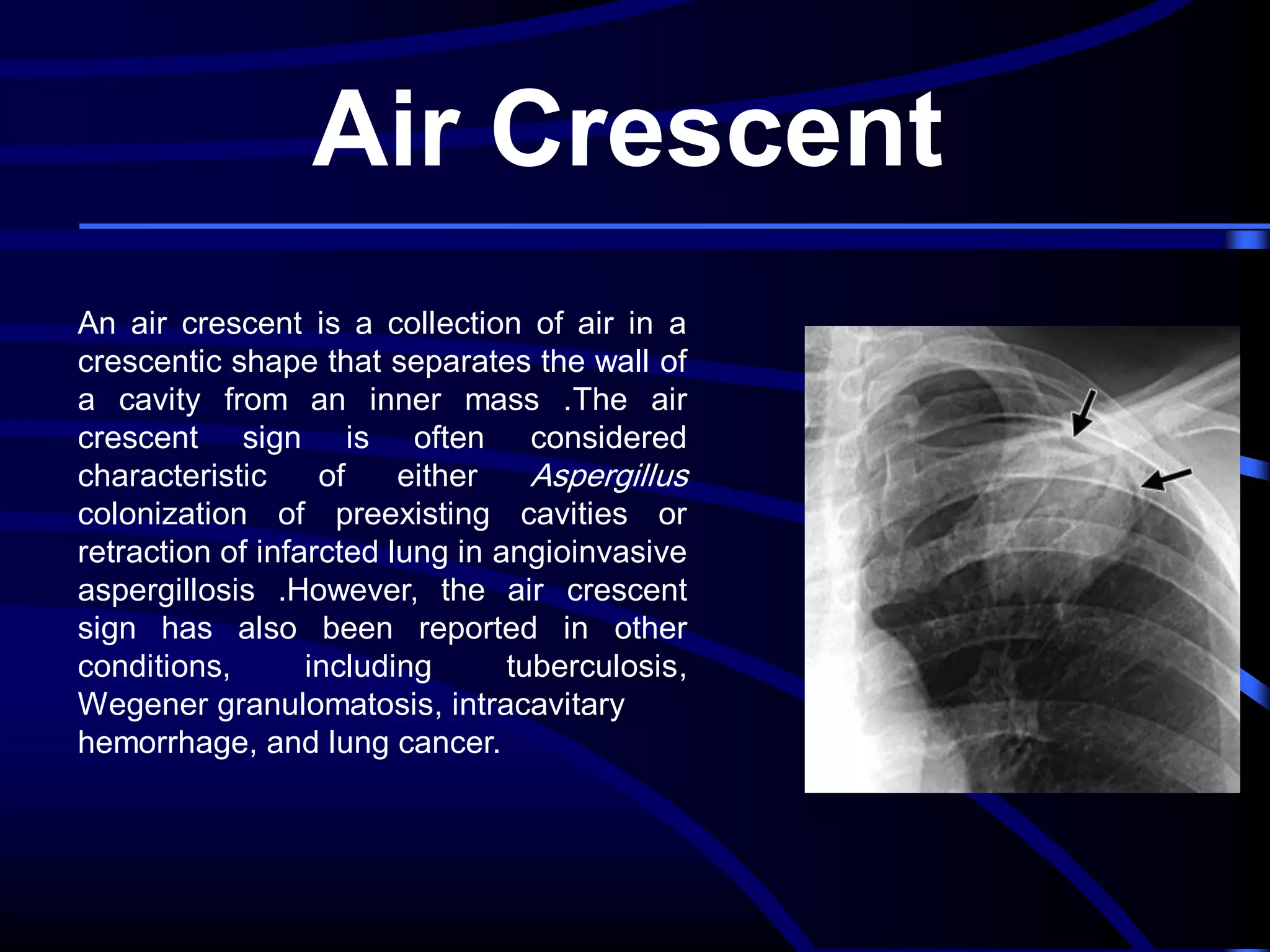 Air Crescent
An air crescent is a collection of air in a
crescentic shape that separates the wall of
a cavity from an inner mass .The air
crescent sign is often considered
characteristic
of
either
Aspergillus
colonization of preexisting cavities or
retraction of infarcted lung in angioinvasive
aspergillosis .However, the air crescent
sign has also been reported in other
conditions,
including
tuberculosis,
Wegener granulomatosis, intracavitary
hemorrhage, and lung cancer.

 
