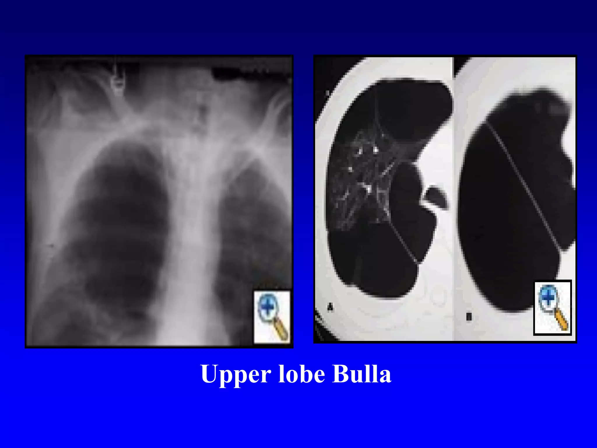 Upper lobe Bulla

 