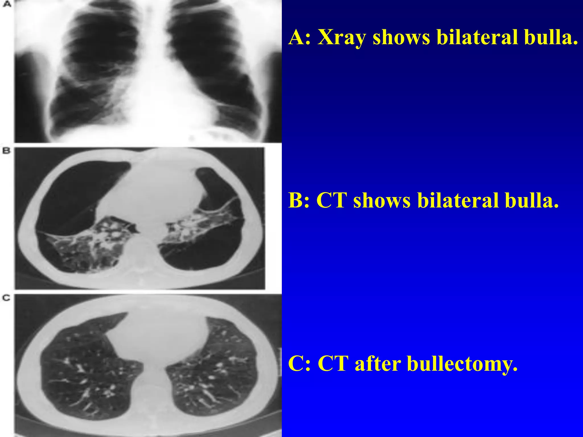 A: Xray shows bilateral bulla.

B: CT shows bilateral bulla.

C: CT after bullectomy.

 