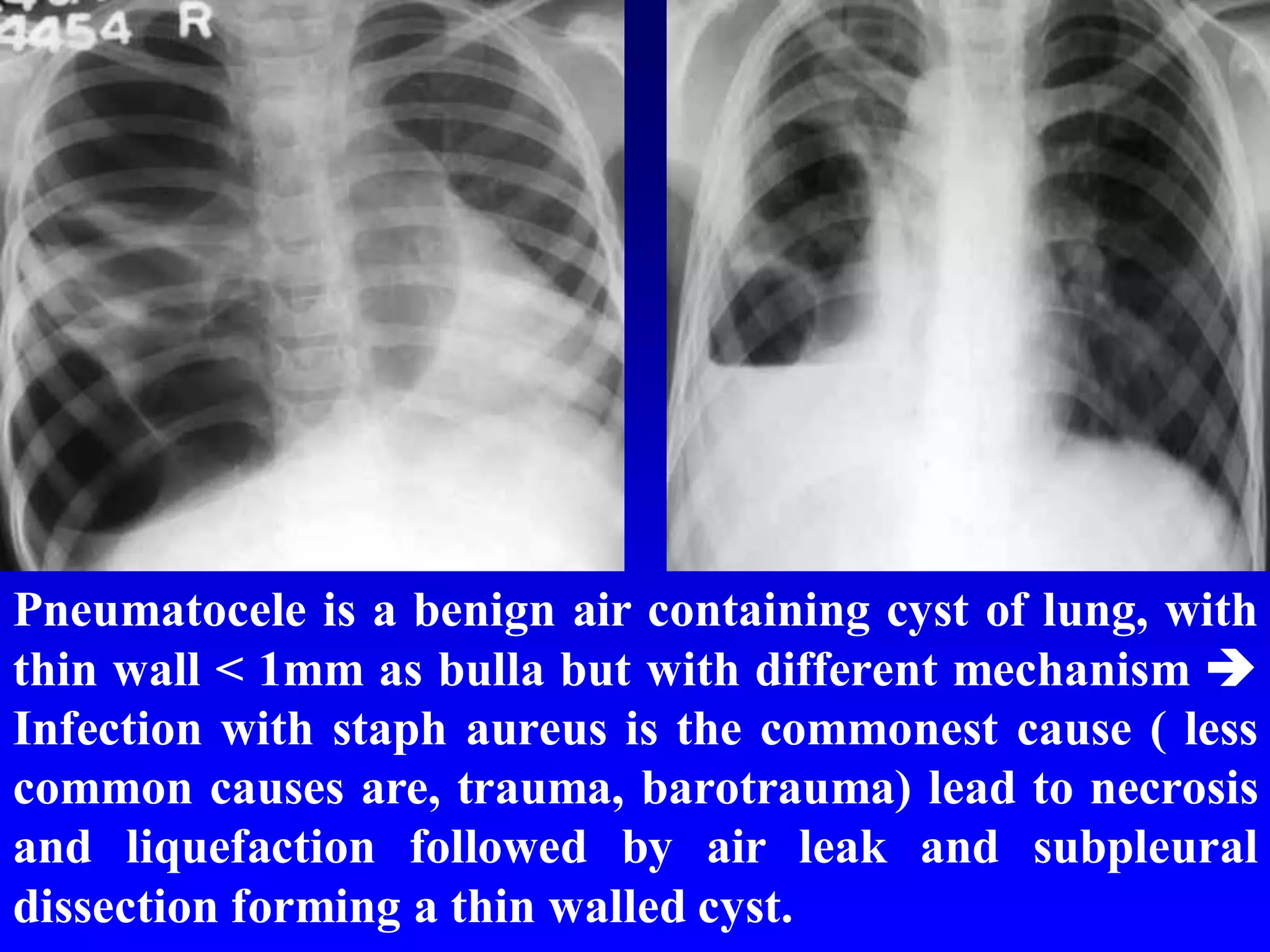 Pneumatocele is a benign air containing cyst of lung, with
thin wall < 1mm as bulla but with different mechanism 
Infection with staph aureus is the commonest cause ( less
common causes are, trauma, barotrauma) lead to necrosis
and liquefaction followed by air leak and subpleural
dissection forming a thin walled cyst.

 