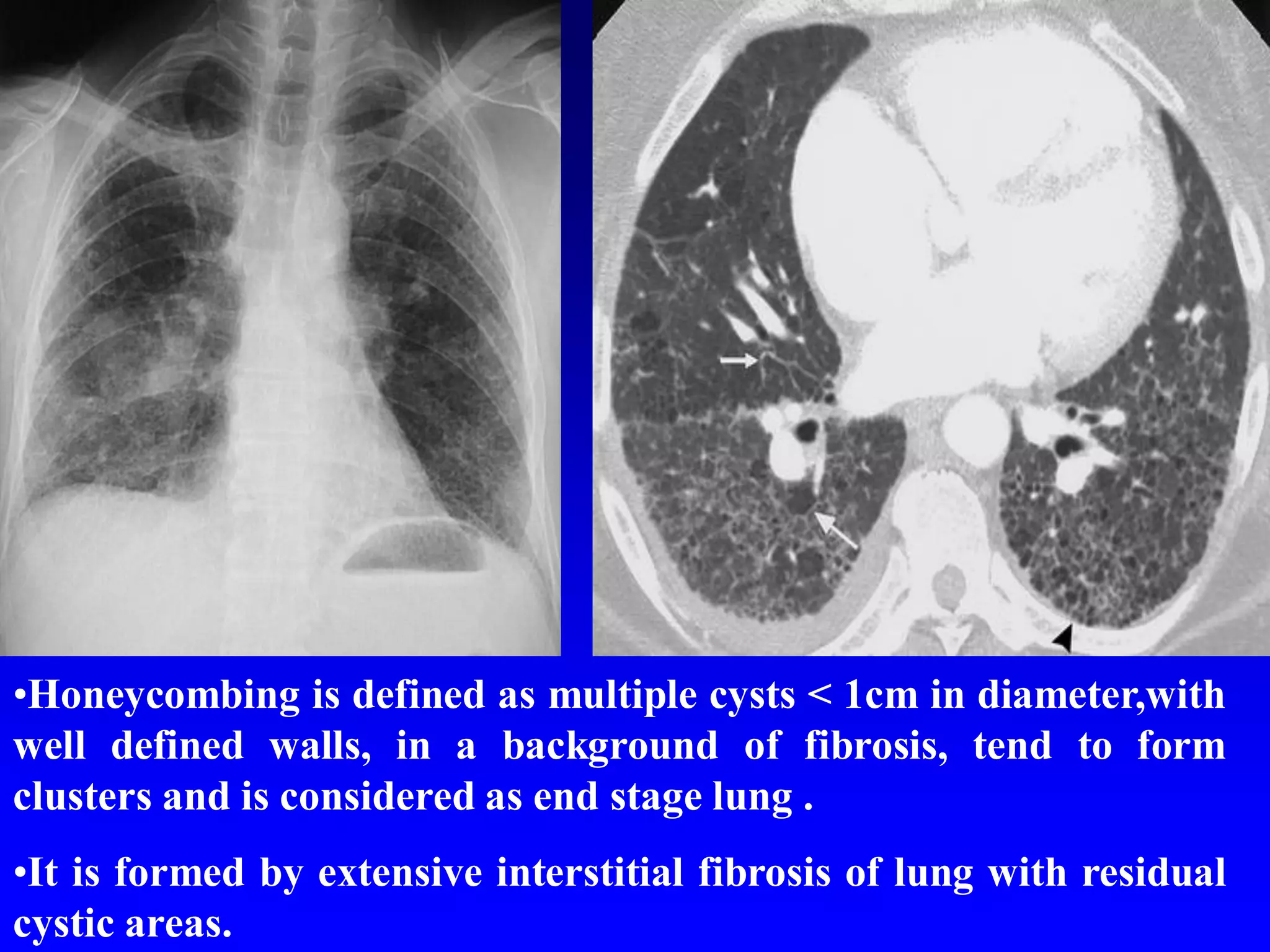 •Honeycombing is defined as multiple cysts < 1cm in diameter,with
well defined walls, in a background of fibrosis, tend to form
clusters and is considered as end stage lung .

•It is formed by extensive interstitial fibrosis of lung with residual
cystic areas.

 