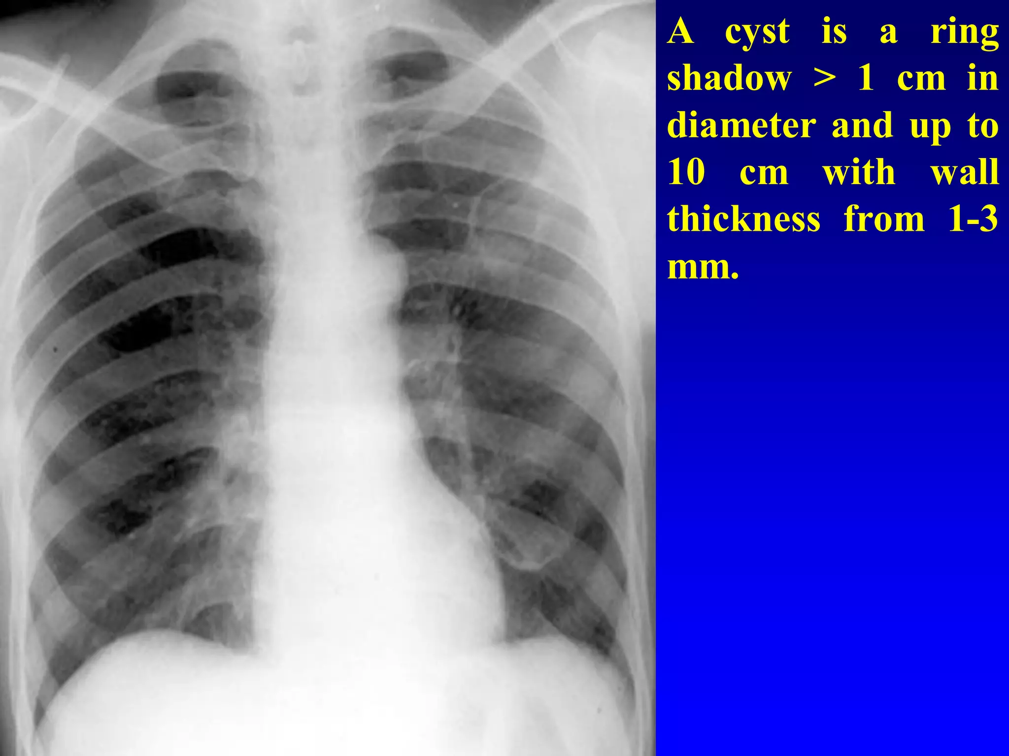A cyst is a ring
shadow > 1 cm in
diameter and up to
10 cm with wall
thickness from 1-3
mm.

 