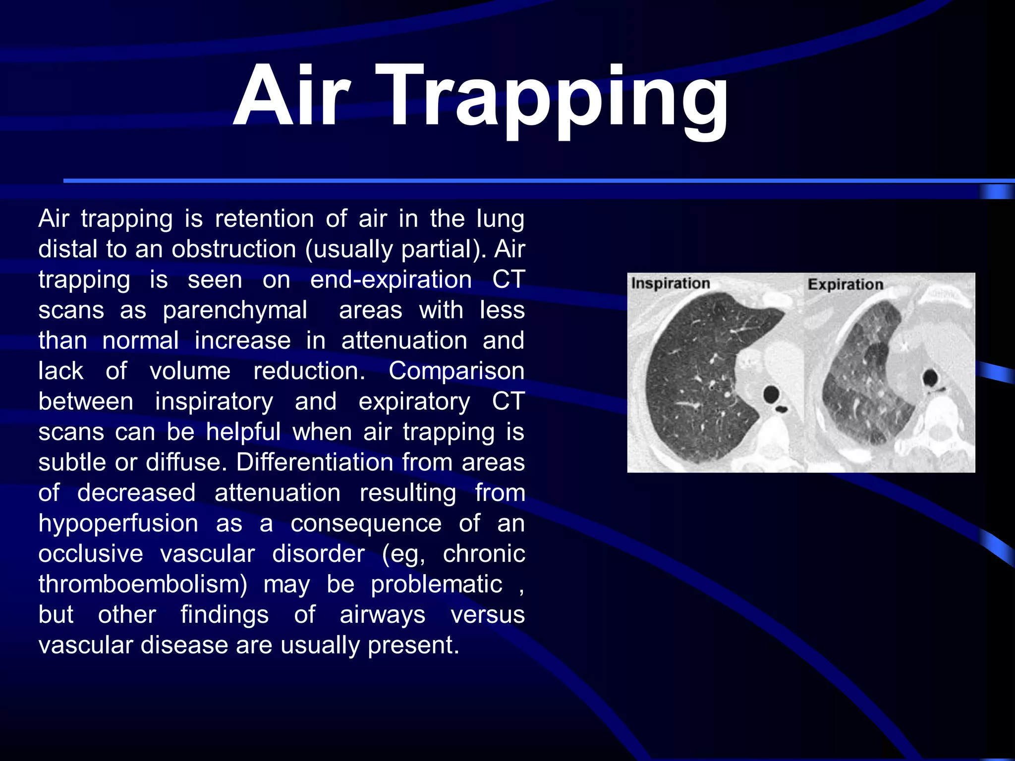 Air Trapping
Air trapping is retention of air in the lung
distal to an obstruction (usually partial). Air
trapping is seen on end-expiration CT
scans as parenchymal areas with less
than normal increase in attenuation and
lack of volume reduction. Comparison
between inspiratory and expiratory CT
scans can be helpful when air trapping is
subtle or diffuse. Differentiation from areas
of decreased attenuation resulting from
hypoperfusion as a consequence of an
occlusive vascular disorder (eg, chronic
thromboembolism) may be problematic ,
but other findings of airways versus
vascular disease are usually present.

 