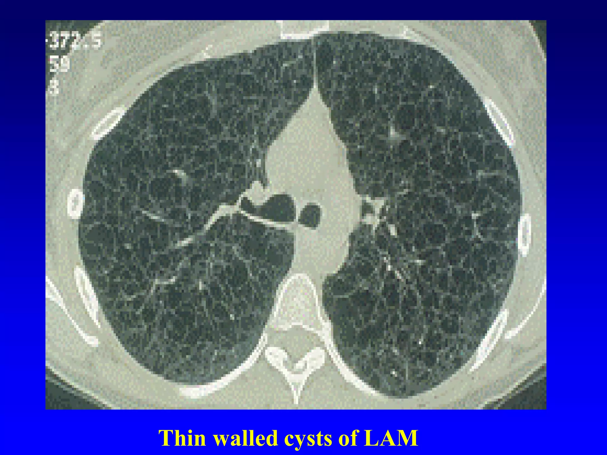 Thin walled cysts of LAM

 