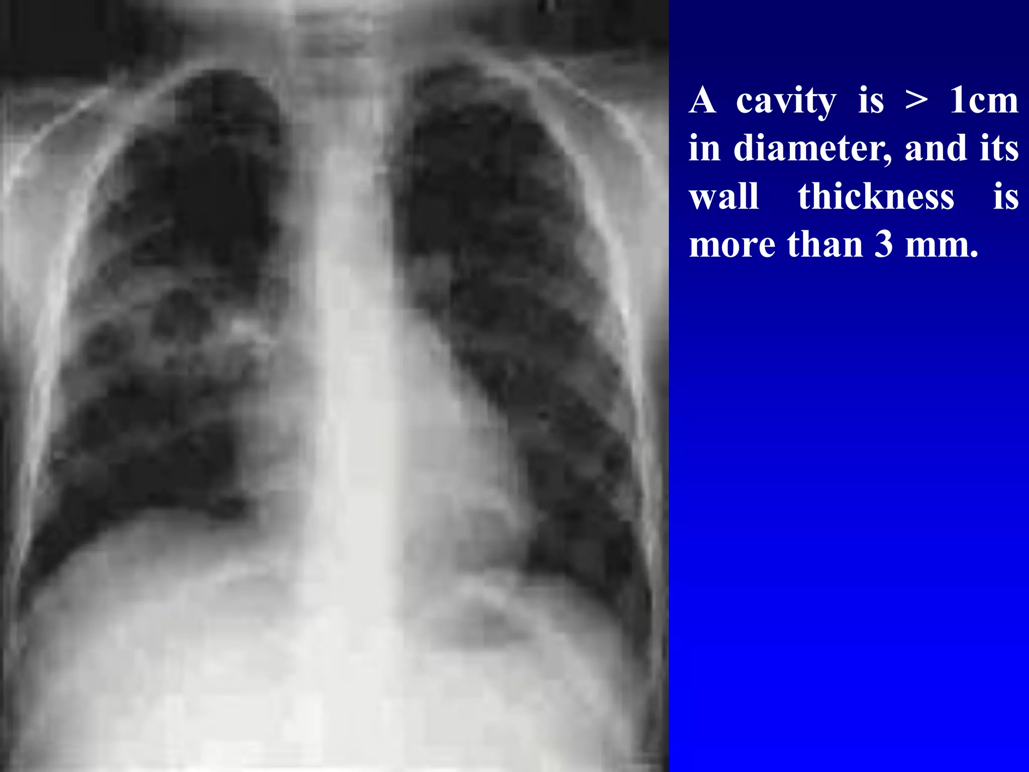 A cavity is > 1cm
in diameter, and its
wall thickness is
more than 3 mm.

 