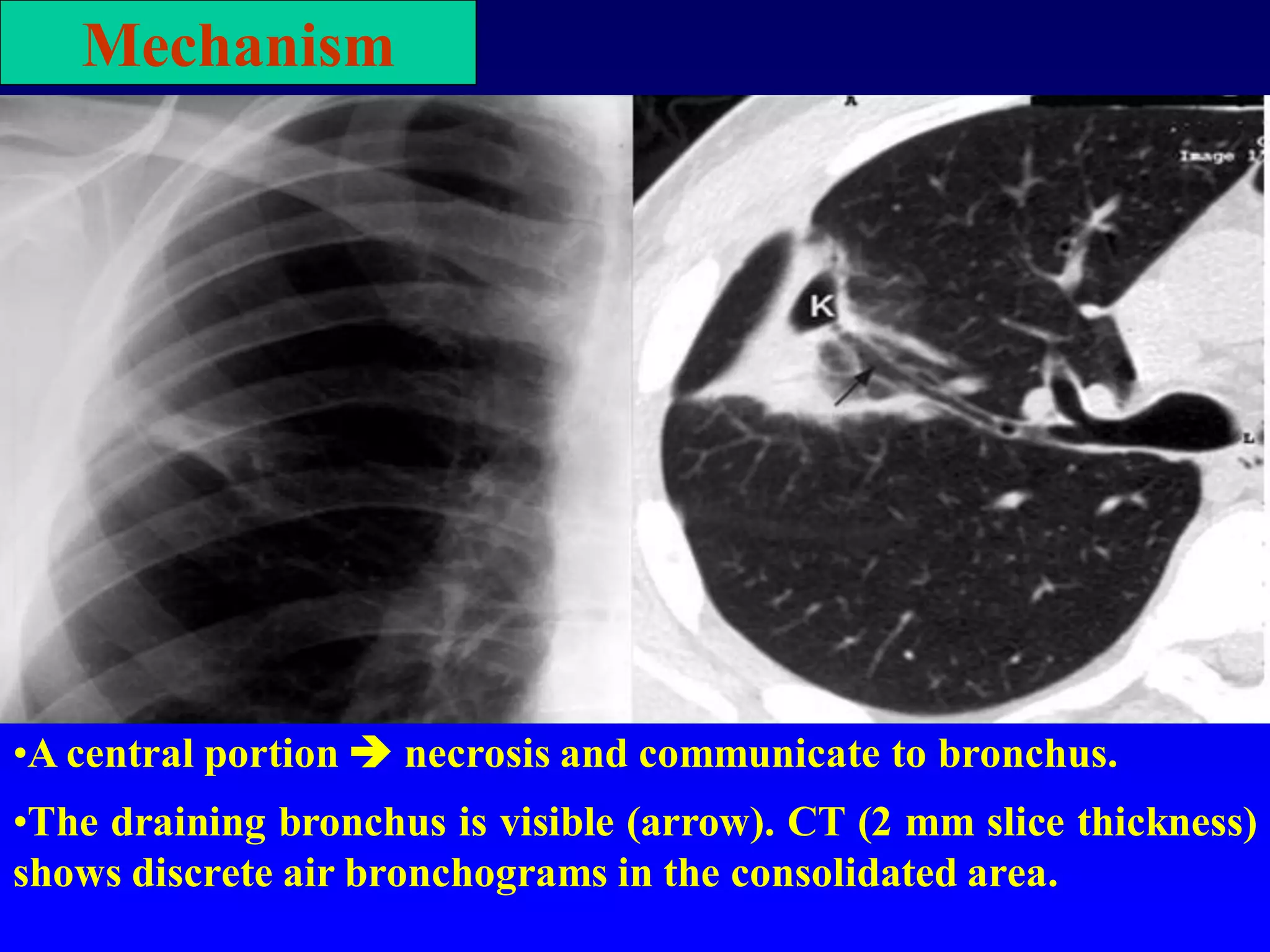 Mechanism

•A central portion  necrosis and communicate to bronchus.
•The draining bronchus is visible (arrow). CT (2 mm slice thickness)
shows discrete air bronchograms in the consolidated area.

 