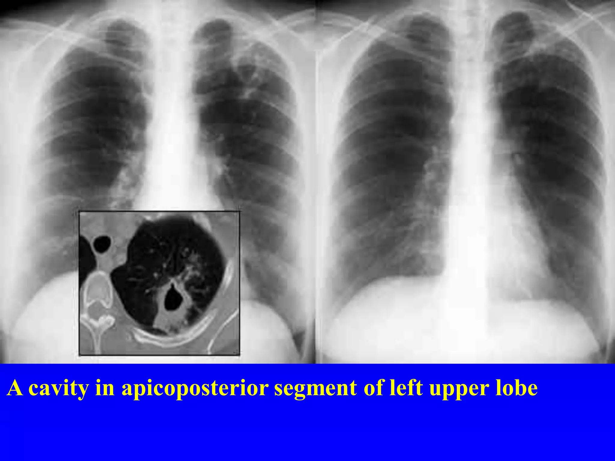 A cavity in apicoposterior segment of left upper lobe

 