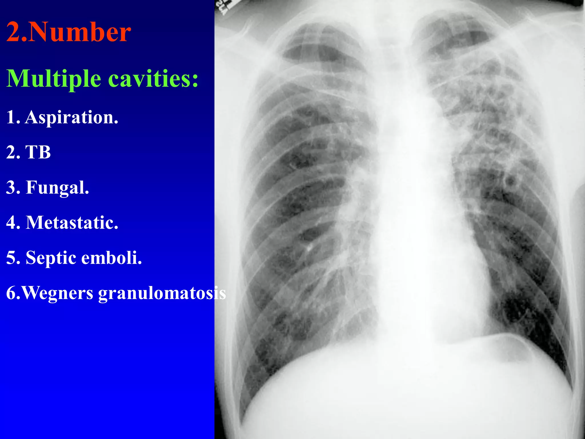 2.Number
Multiple cavities:
1. Aspiration.
2. TB
3. Fungal.
4. Metastatic.

5. Septic emboli.
6.Wegners granulomatosis

 