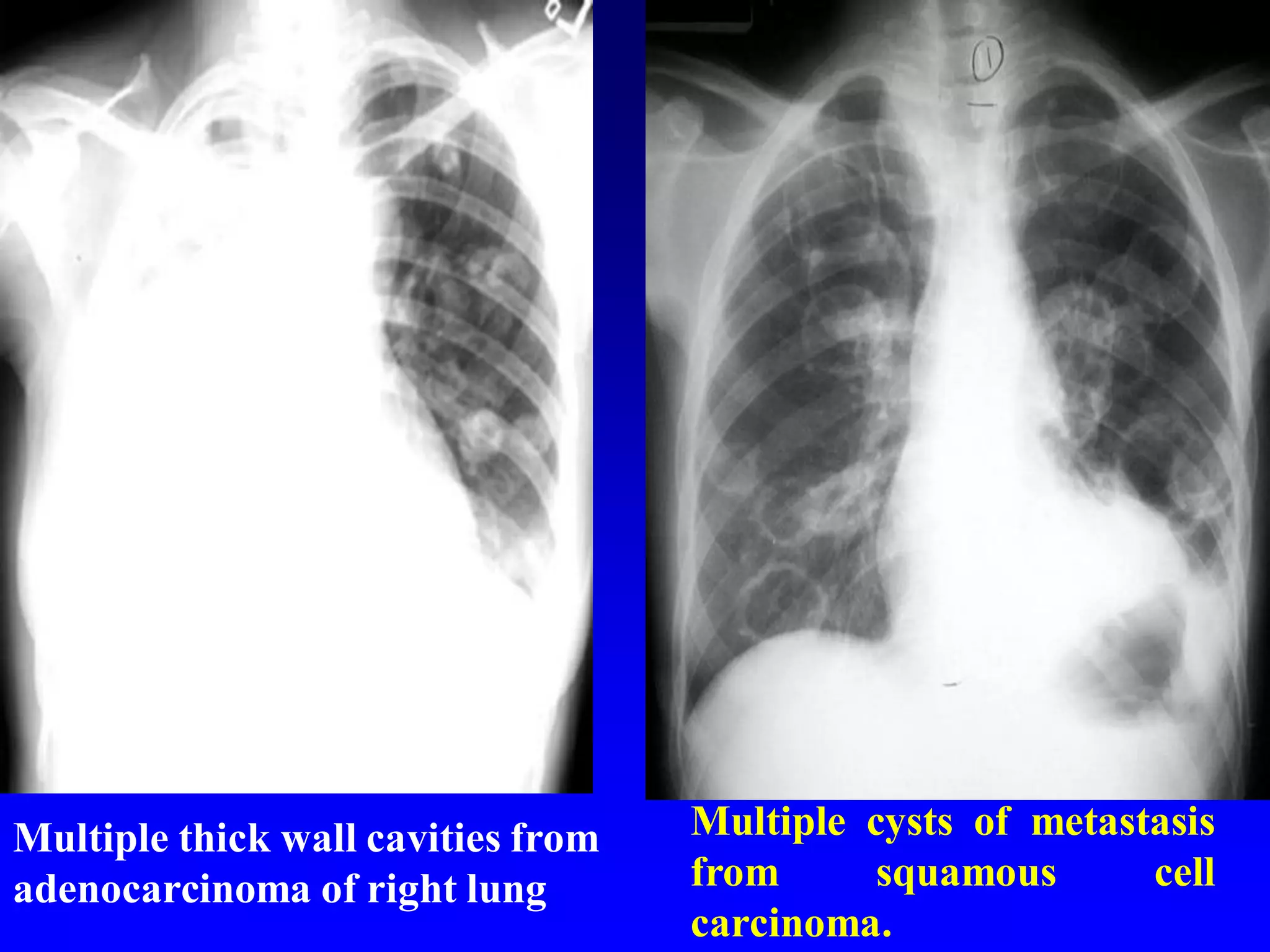 Multiple thick wall cavities from
adenocarcinoma of right lung

Multiple cysts of metastasis
from
squamous
cell
carcinoma.

 