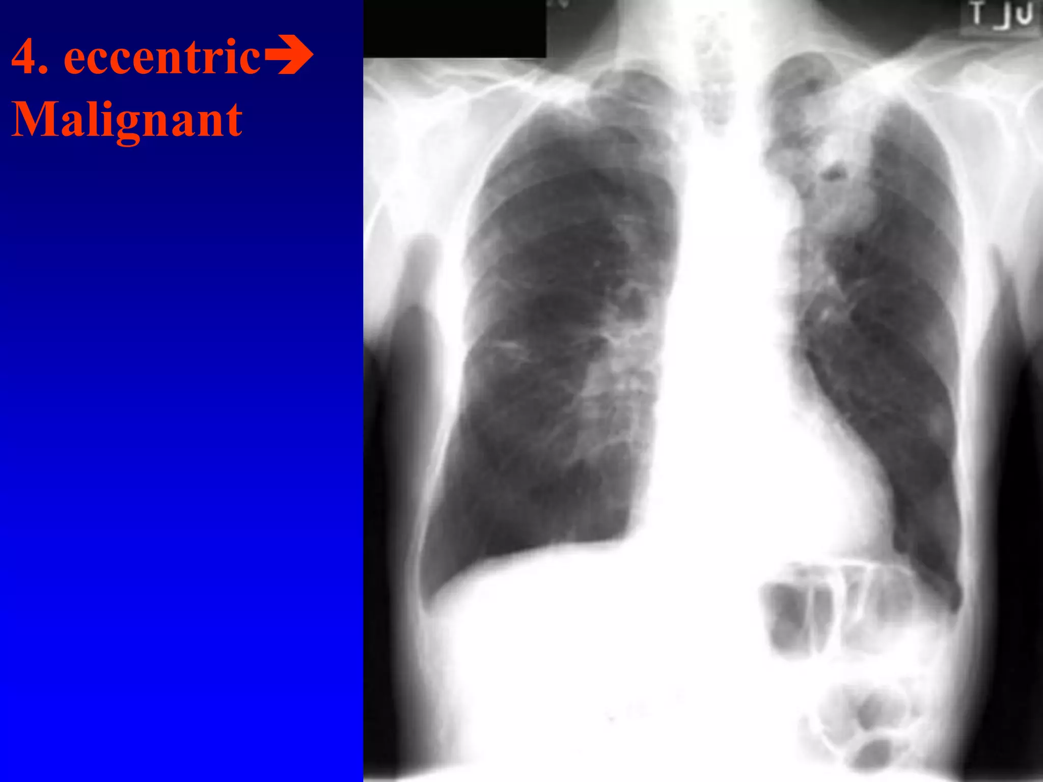 4. eccentric
Malignant

 