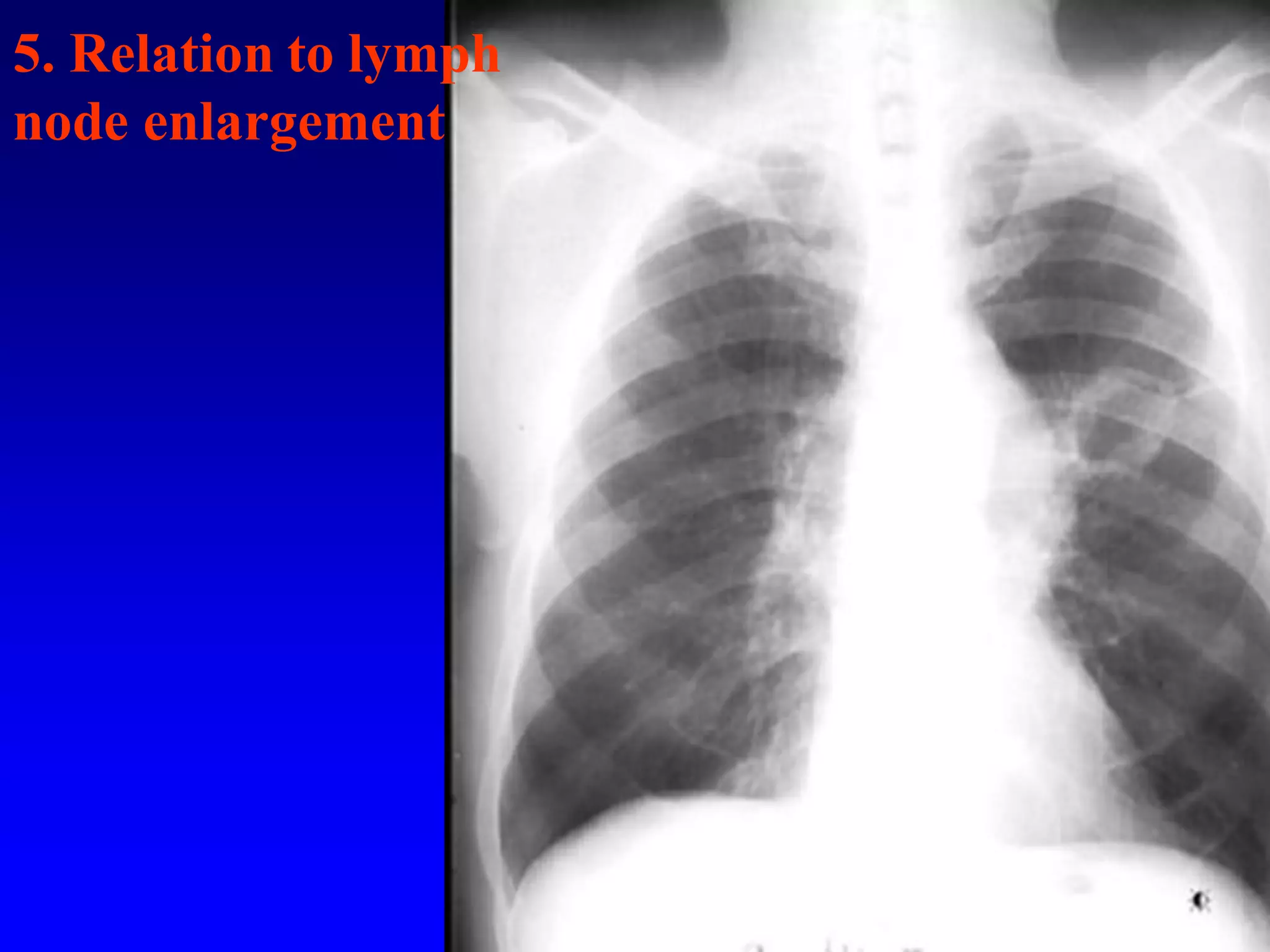 5. Relation to lymph
node enlargement

 