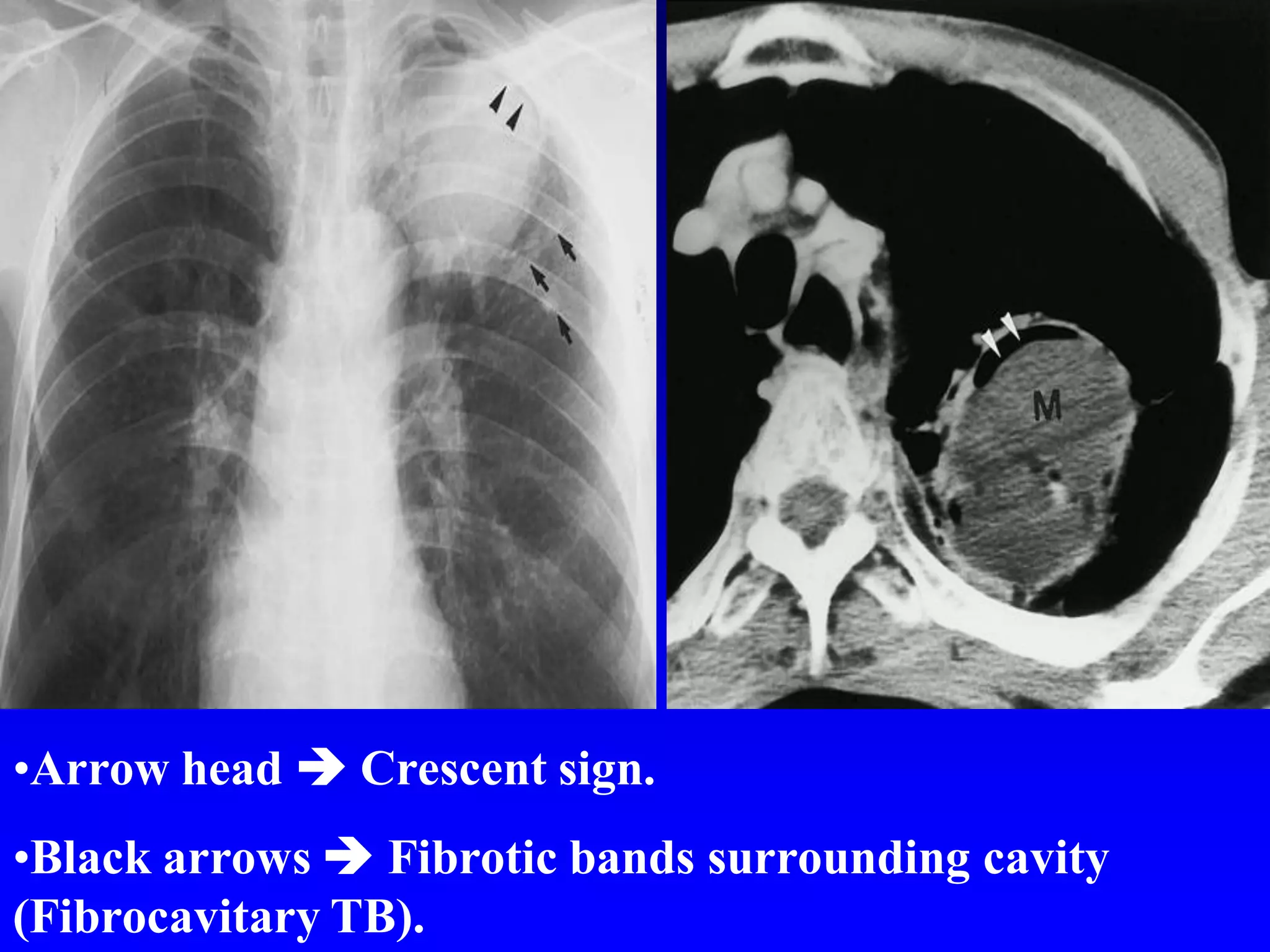 •Arrow head  Crescent sign.
•Black arrows  Fibrotic bands surrounding cavity
(Fibrocavitary TB).

 