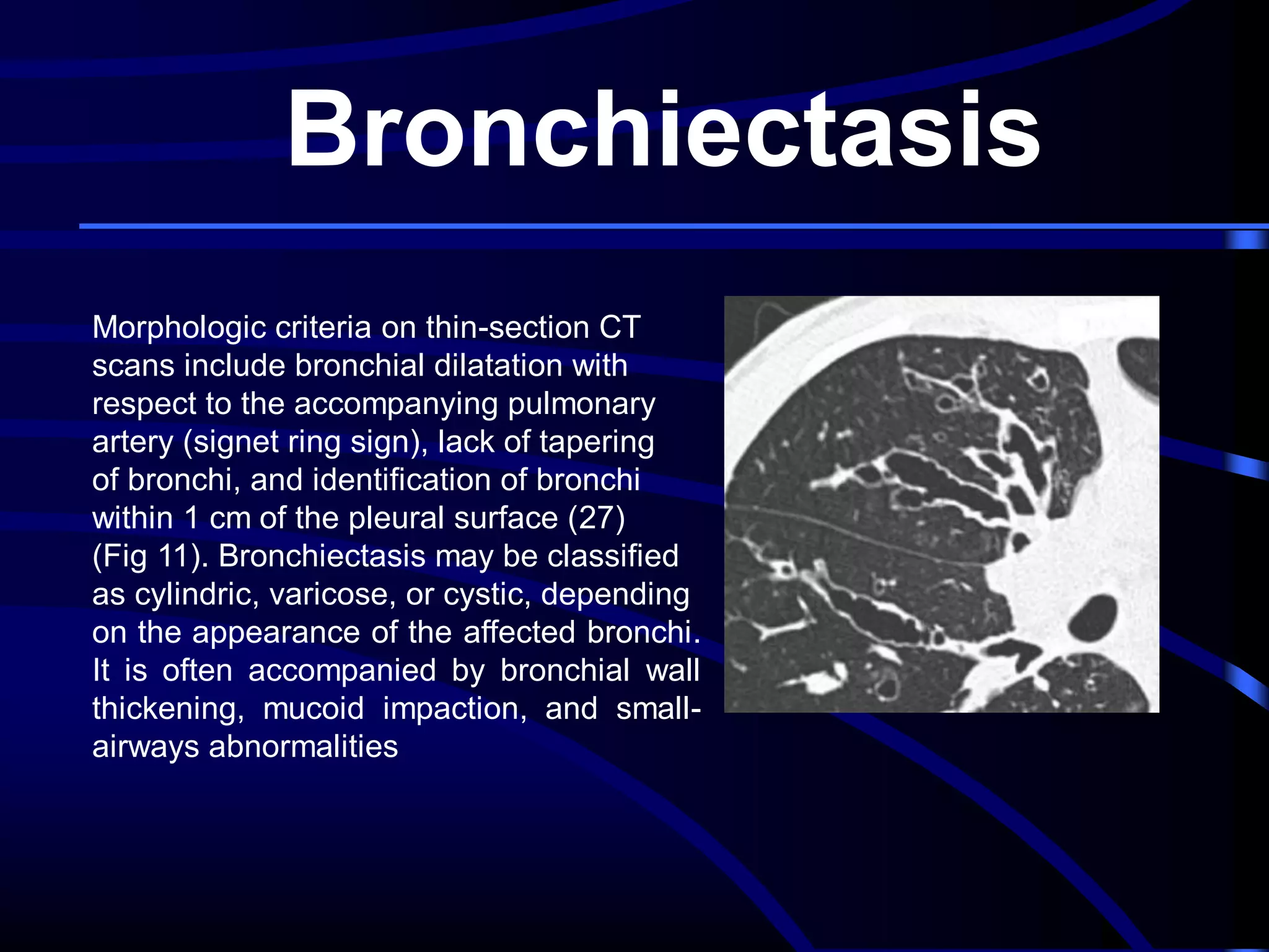 Bronchiectasis
Morphologic criteria on thin-section CT
scans include bronchial dilatation with
respect to the accompanying pulmonary
artery (signet ring sign), lack of tapering
of bronchi, and identification of bronchi
within 1 cm of the pleural surface (27)
(Fig 11). Bronchiectasis may be classified
as cylindric, varicose, or cystic, depending
on the appearance of the affected bronchi.
It is often accompanied by bronchial wall
thickening, mucoid impaction, and smallairways abnormalities

 
