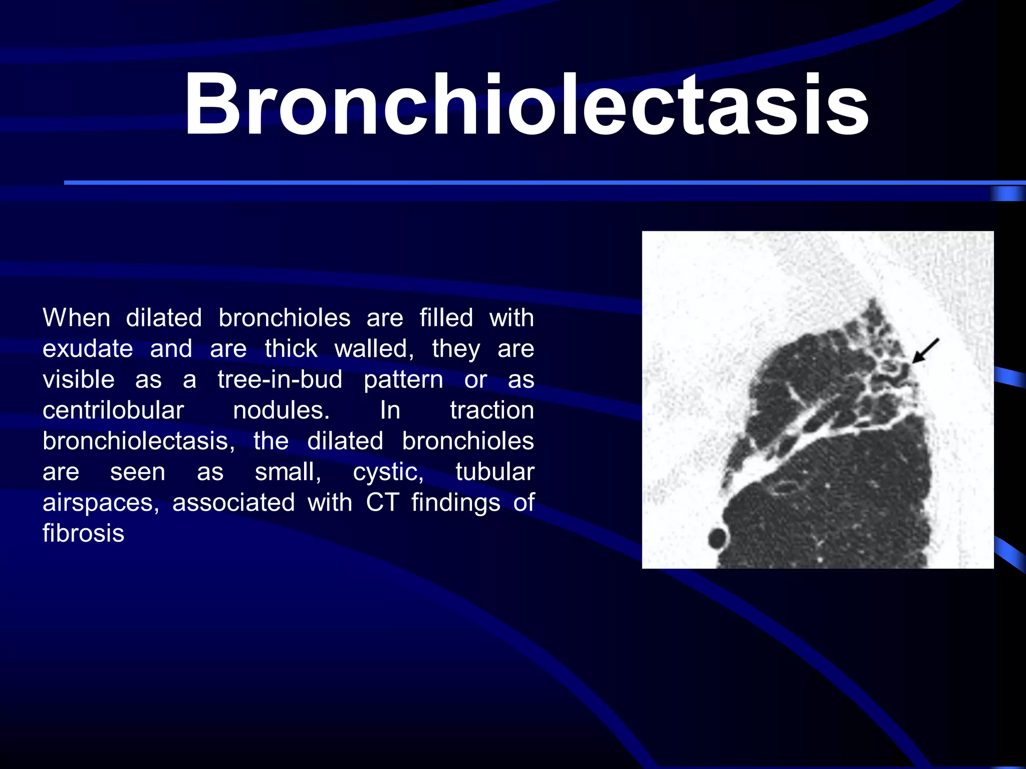 Bronchiolectasis
When dilated bronchioles are filled with
exudate and are thick walled, they are
visible as a tree-in-bud pattern or as
centrilobular
nodules.
In
traction
bronchiolectasis, the dilated bronchioles
are seen as small, cystic, tubular
airspaces, associated with CT findings of
fibrosis

 